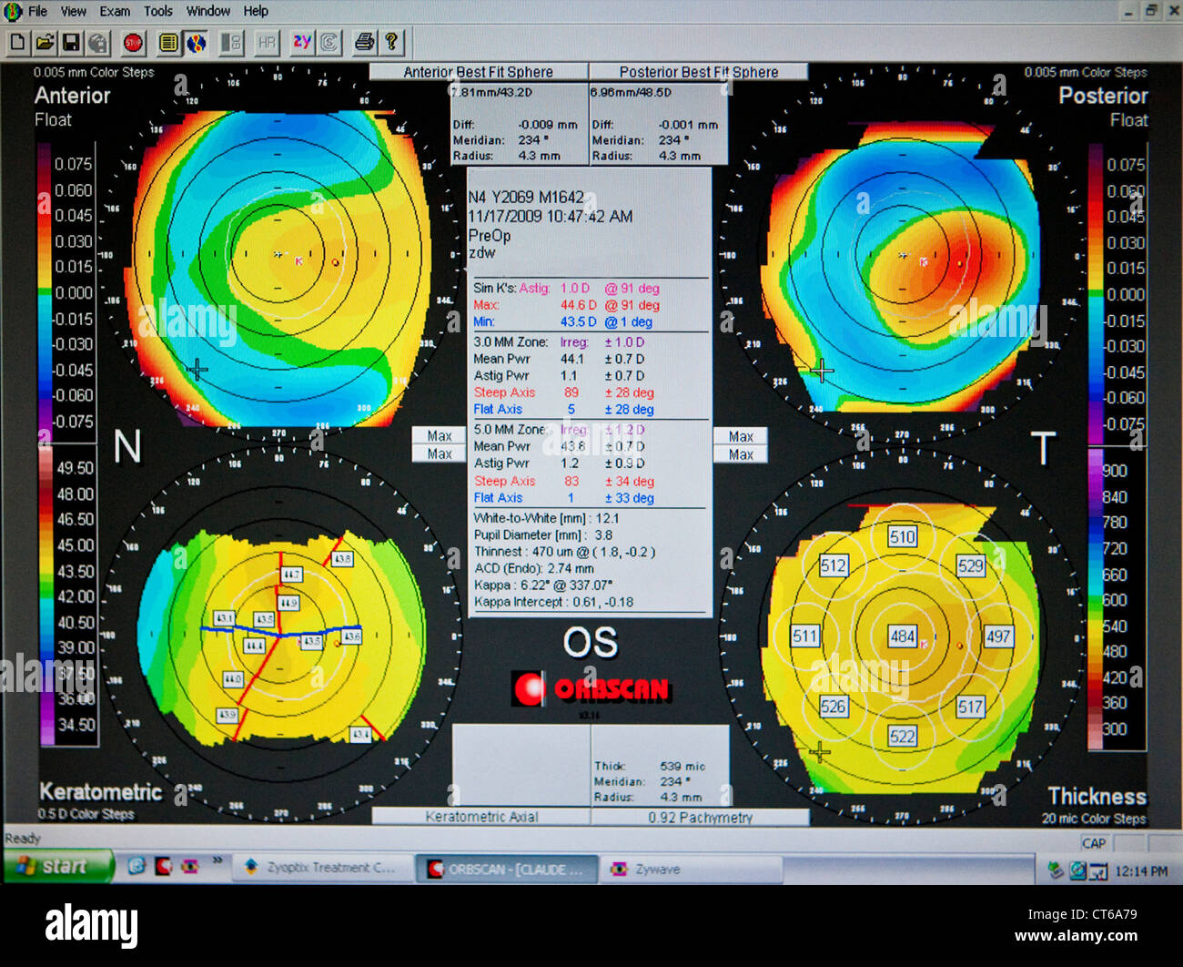 CORNEAL TOPOGRAPHY RESULT Stock Photo