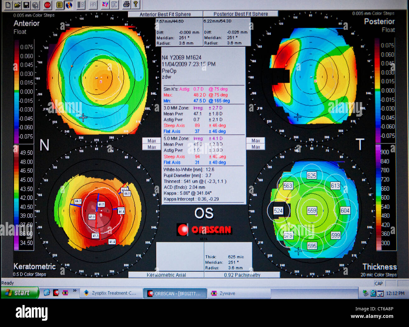 CORNEAL TOPOGRAPHY RESULT Stock Photo