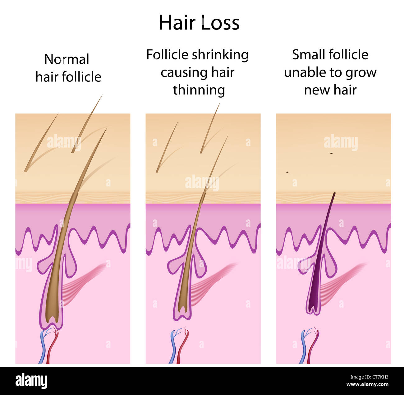 Hair Follicle Head Stock Photos Hair Follicle Head Stock Images