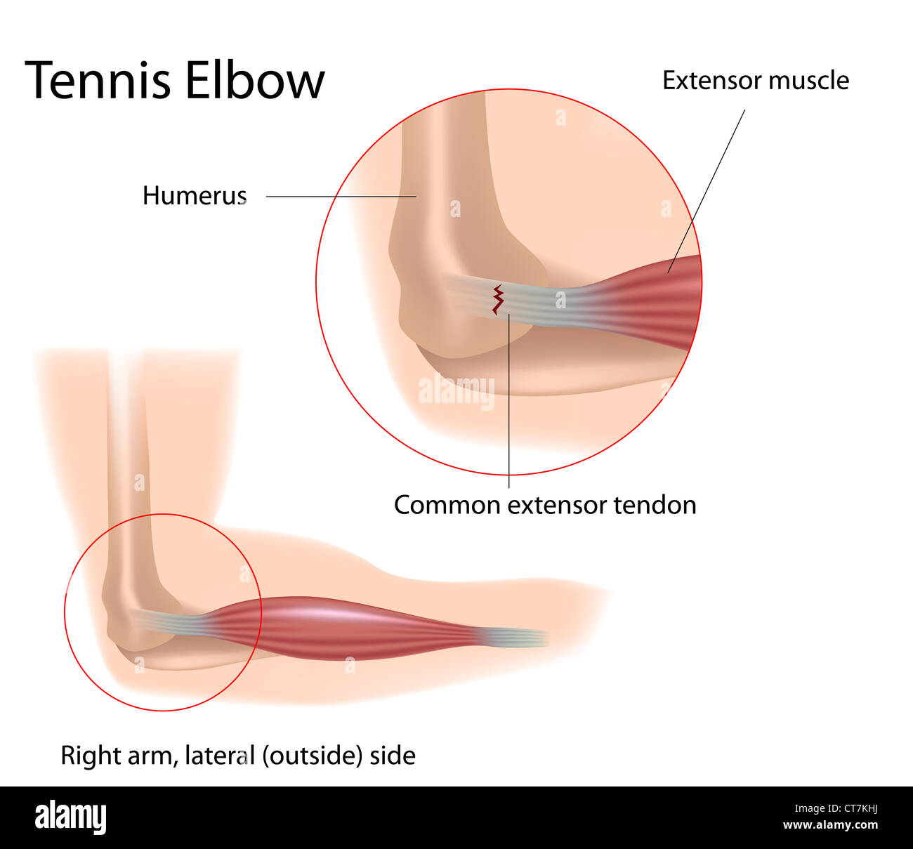 Tennis elbow hi-res stock photography and images - Alamy