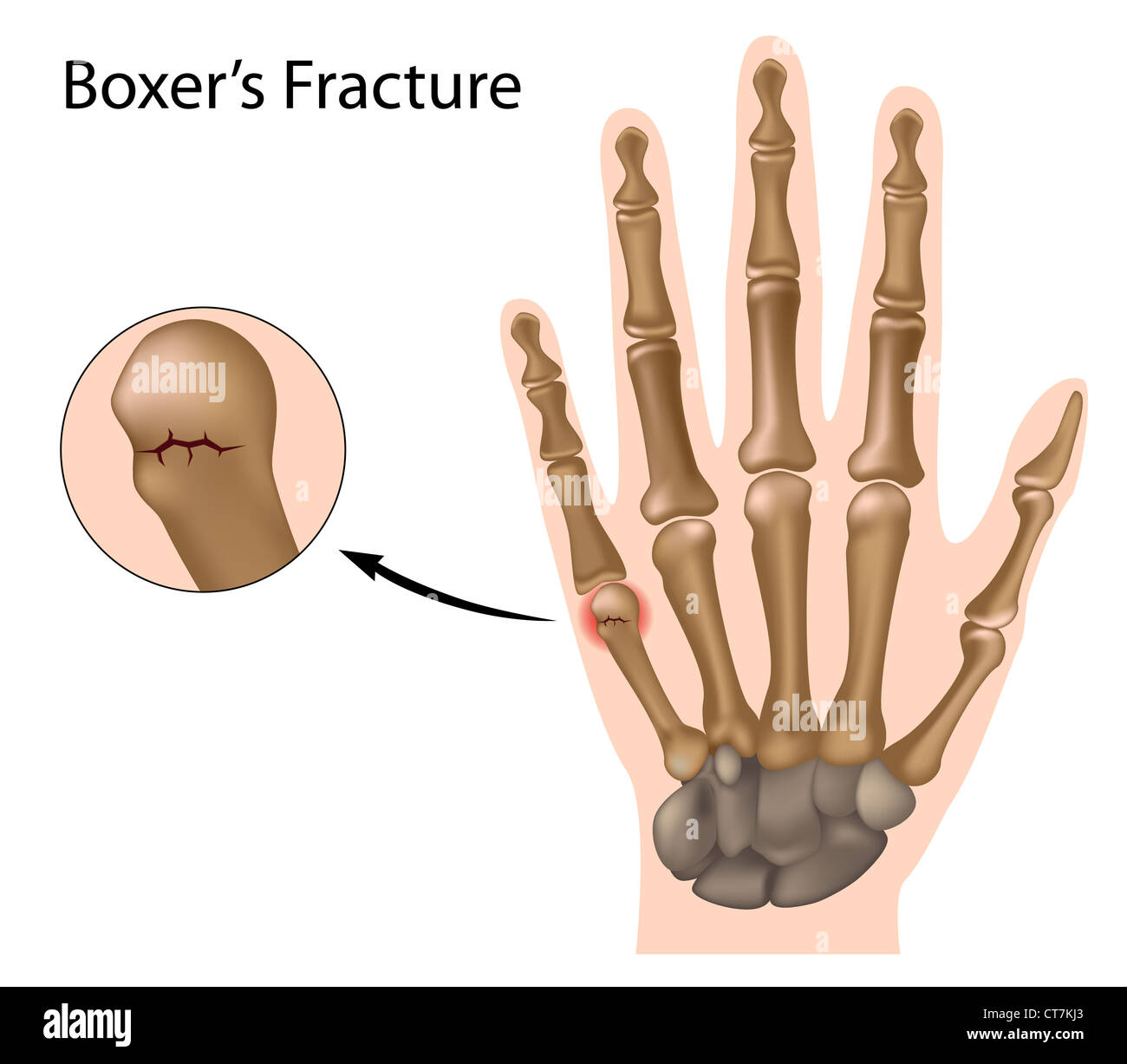 Boxers fracture hi-res stock photography and images - Alamy
