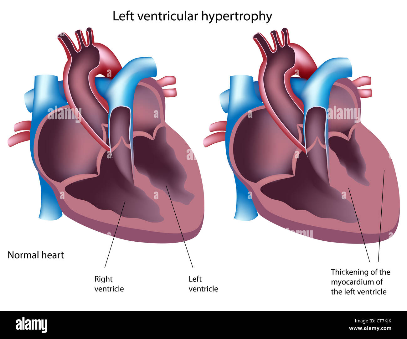 Left ventricular hypertrophy hi-res stock photography and images - Alamy