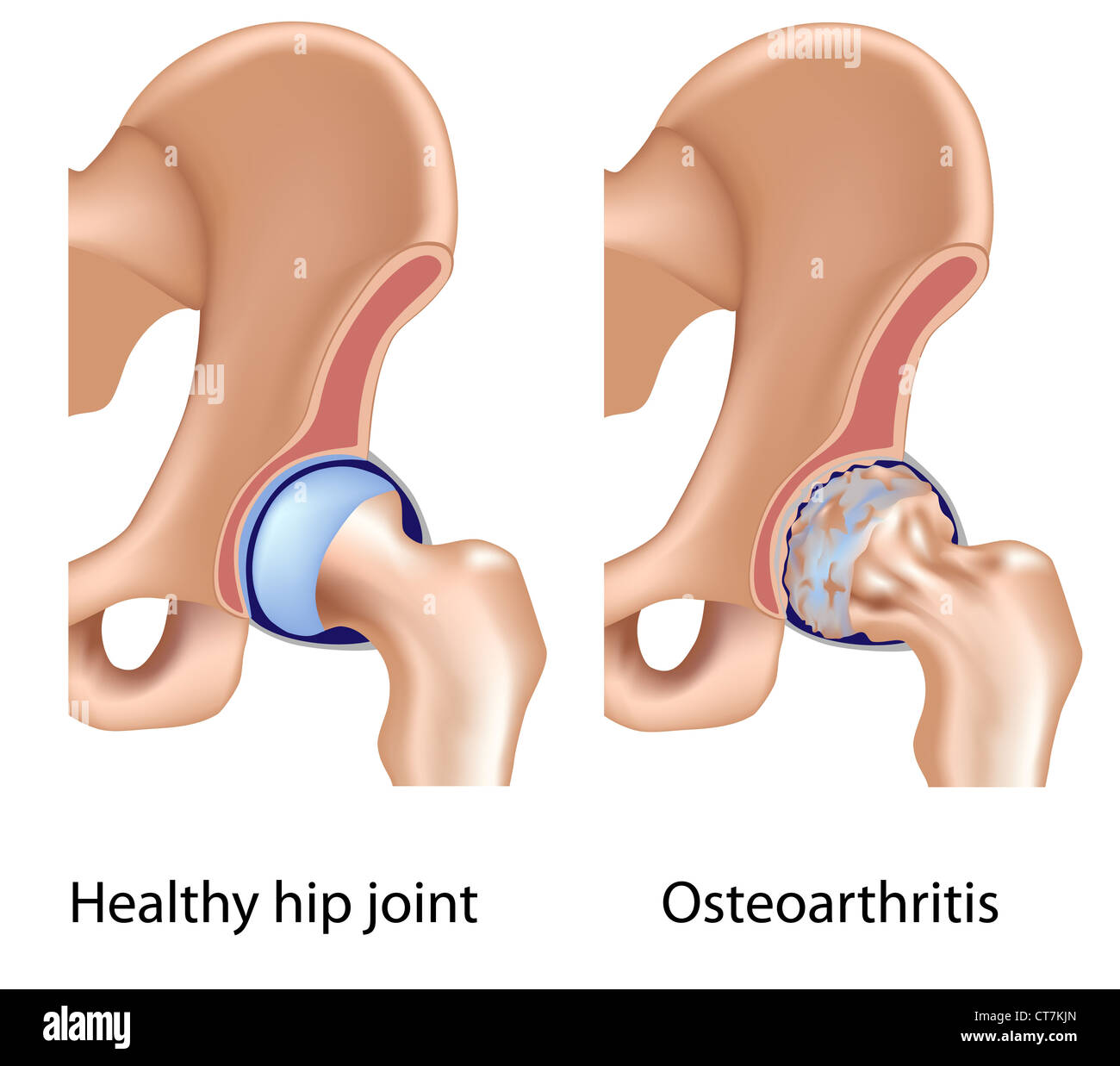 Osteoarthritis of hip joint Stock Photo