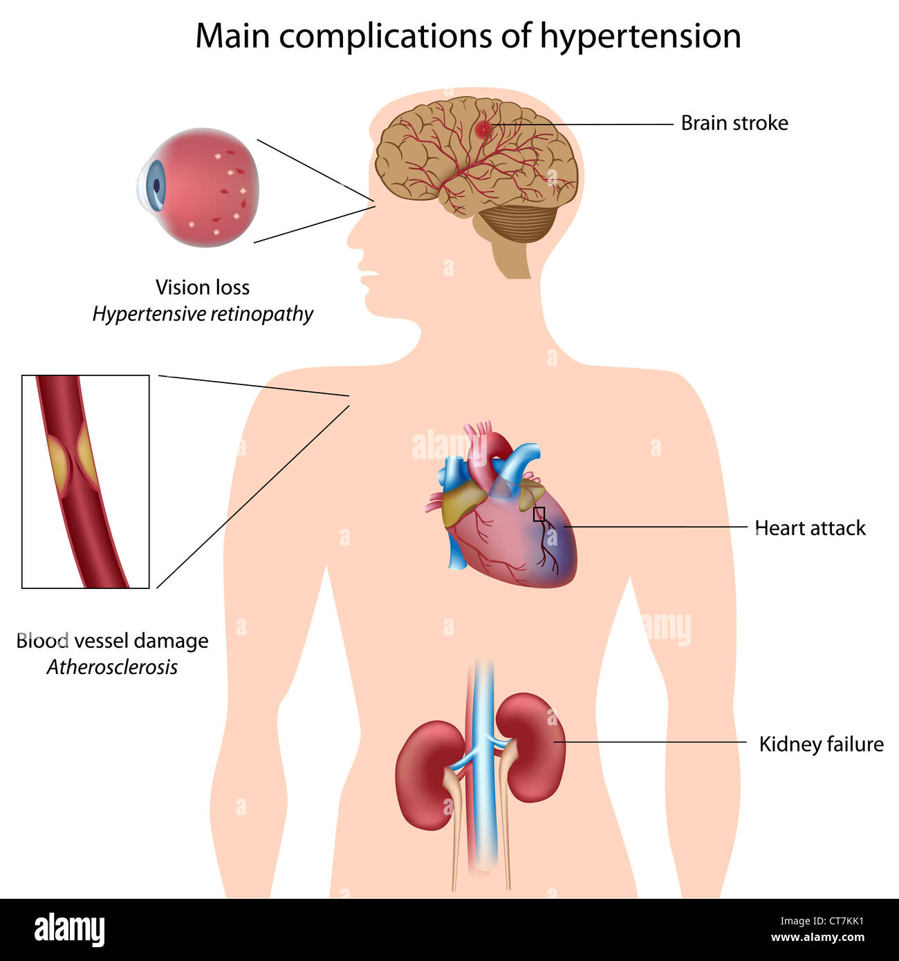 Hypertension complications Stock Photo