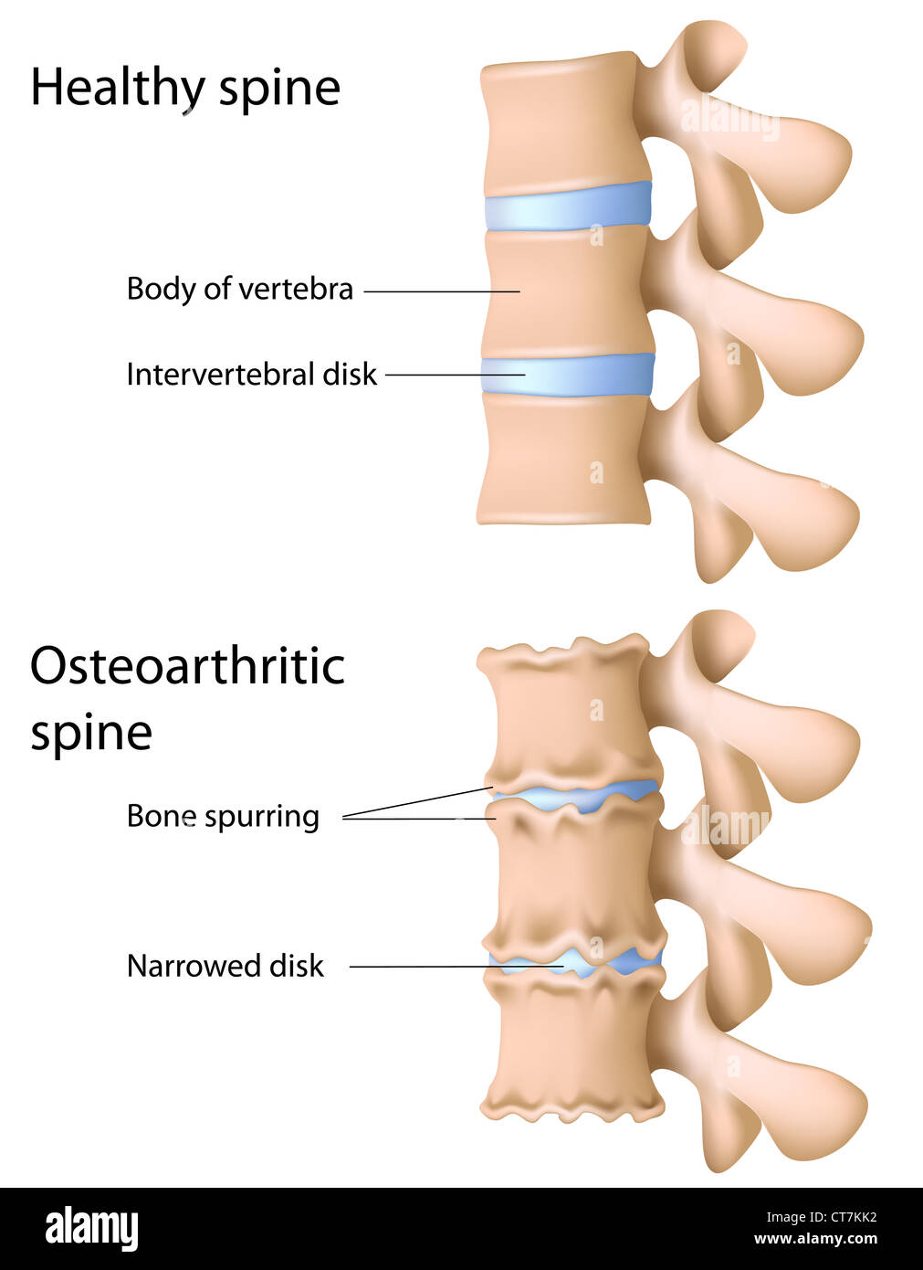 Osteoarthritis of the spine Stock Photo Alamy