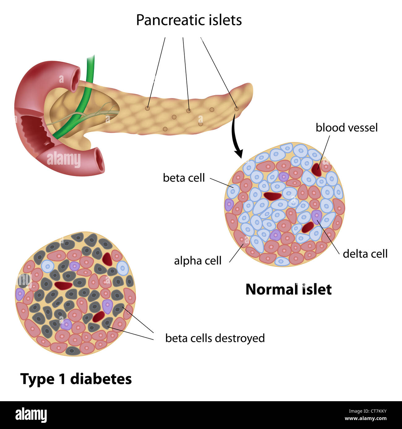 Pancreatic islet normal and type 1 diabetic Stock Photo