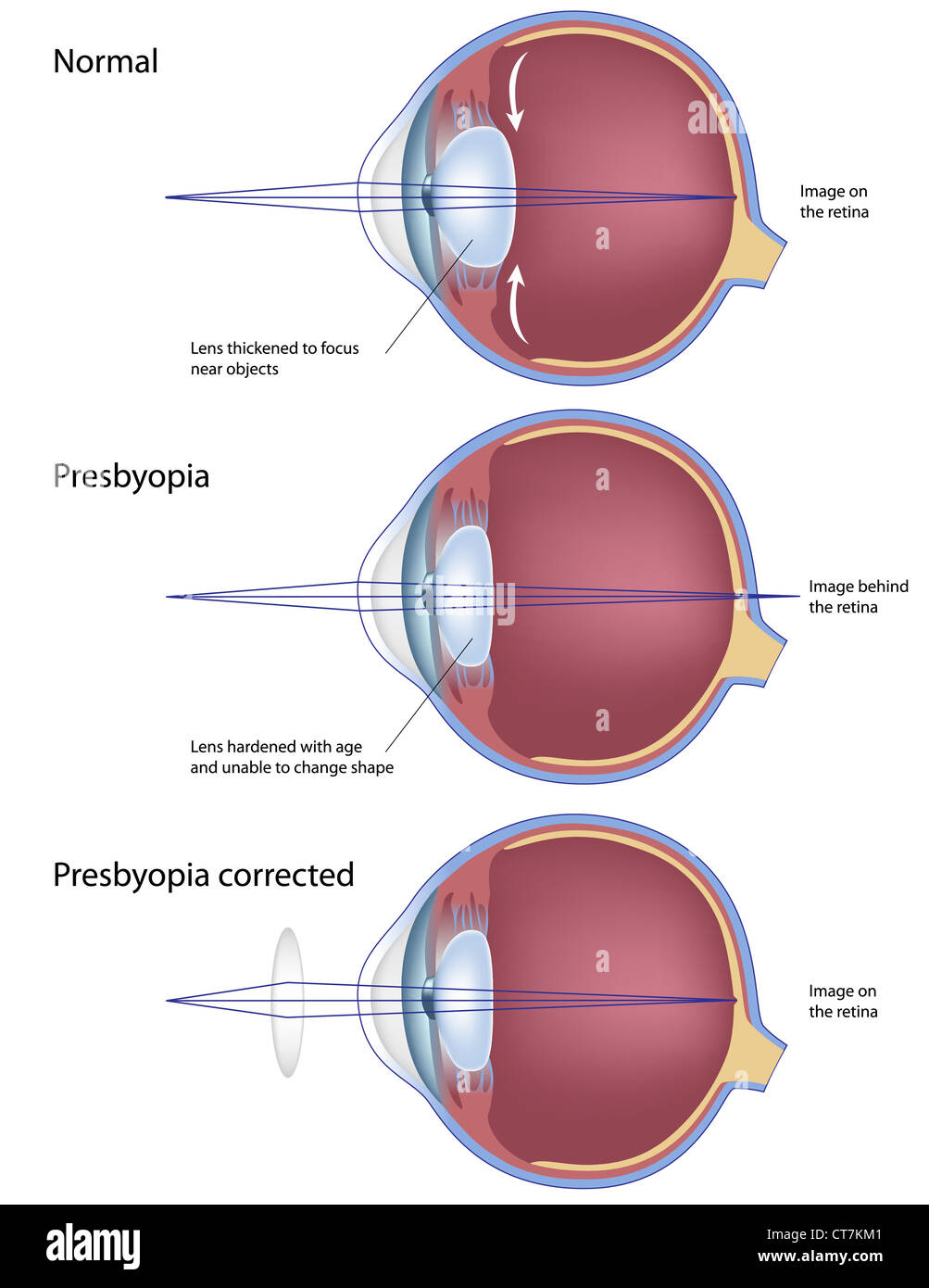 Eye condition presbyopia and correction Stock Photo