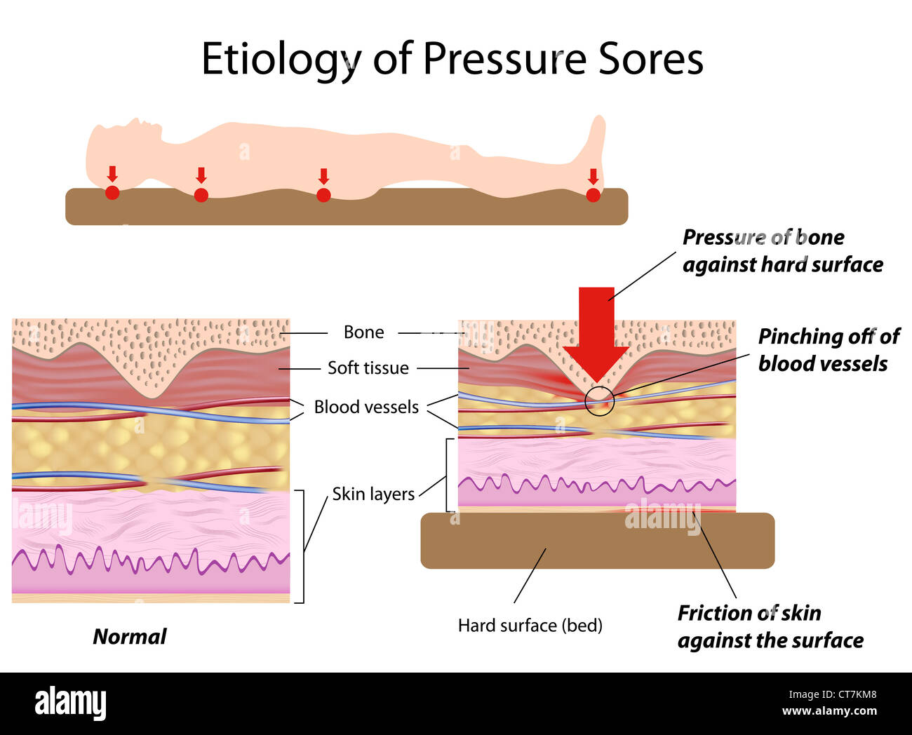 Etiology of pressure sores Stock Photo