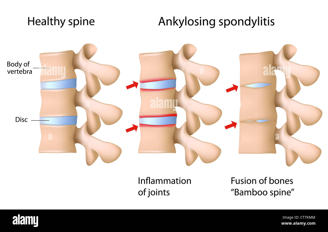 2019 year - What Kind of Arthritis Is Ankylosing Spondylitis 2019 year