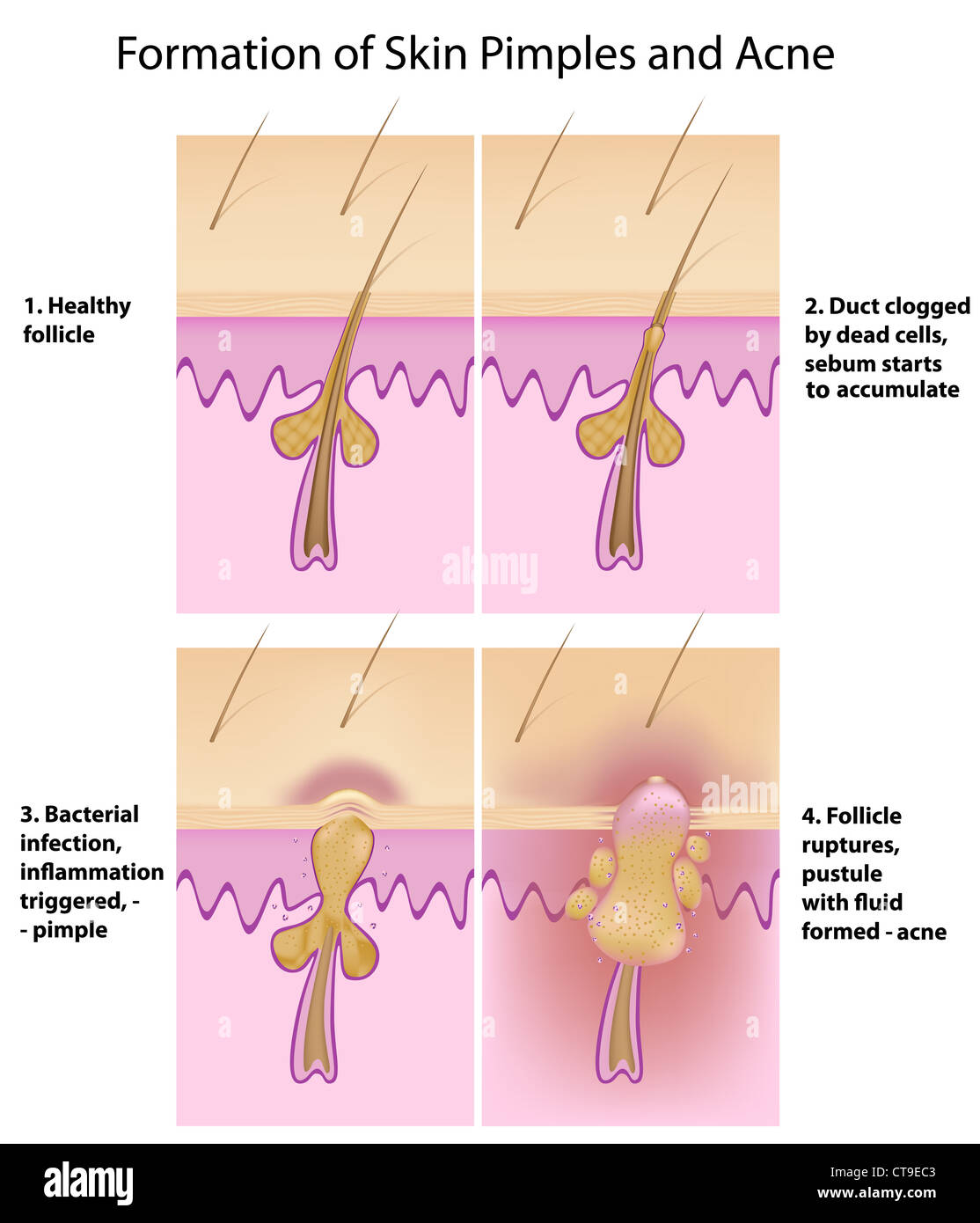 Follicle duct hi-res stock photography and images - Alamy