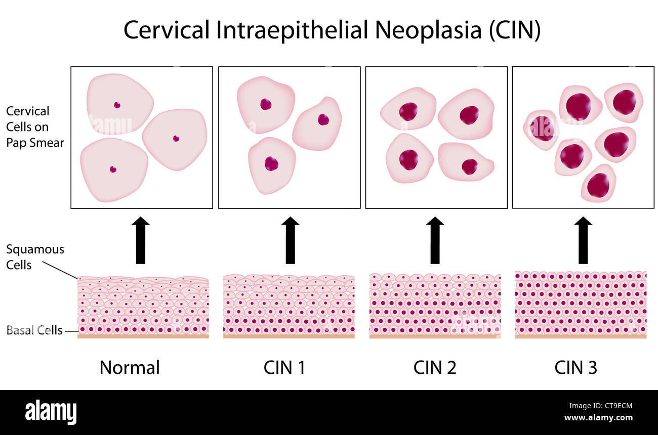 Cervical Dysplasia Stages And Cervix Cell Morphology On Pap Smear Test ...