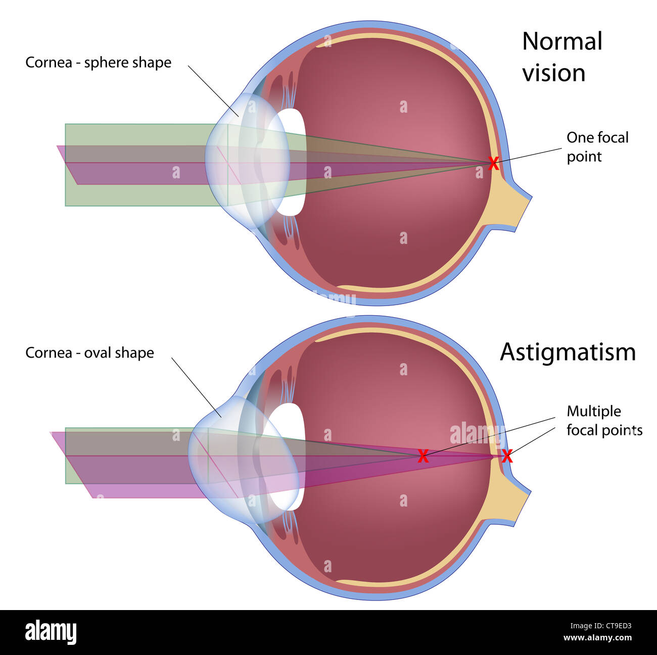 Astigmatism, a common eye defect Stock Photo