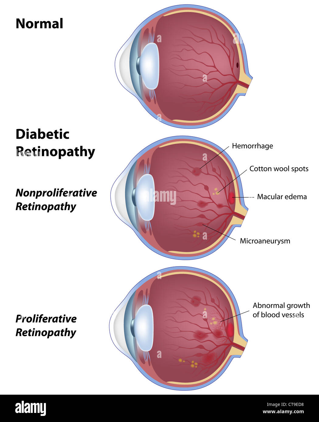 Diabetic retinopathy Stock Photo