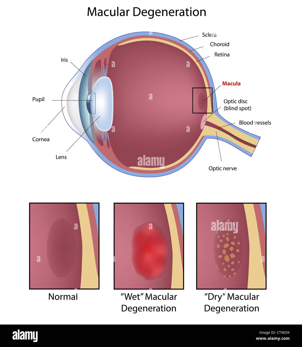 Eye condition: macular degeneration Stock Photo