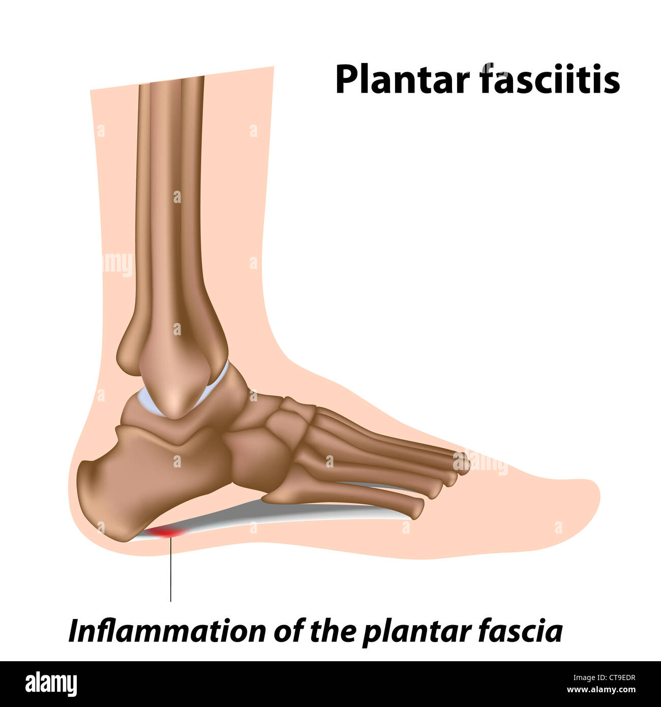 Plantar fasciitis, foot problem Stock Photo