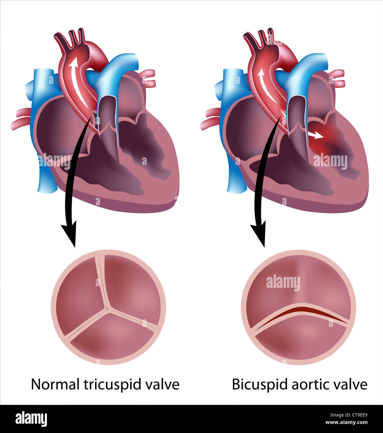 Heart valve defect, bicuspid aortic valve Stock Photo
