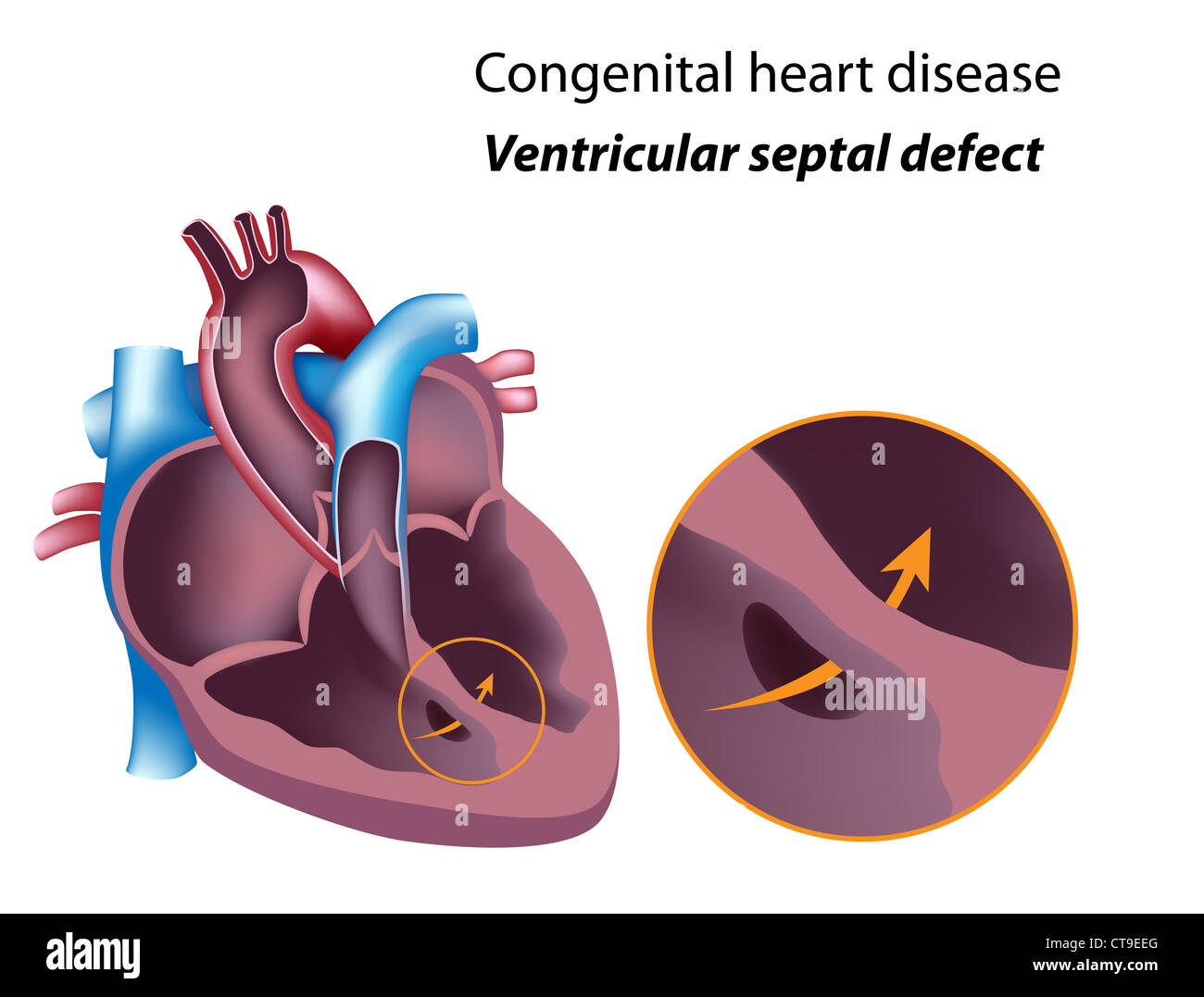 Congenital heart disease: ventricular septal defect Stock Photo