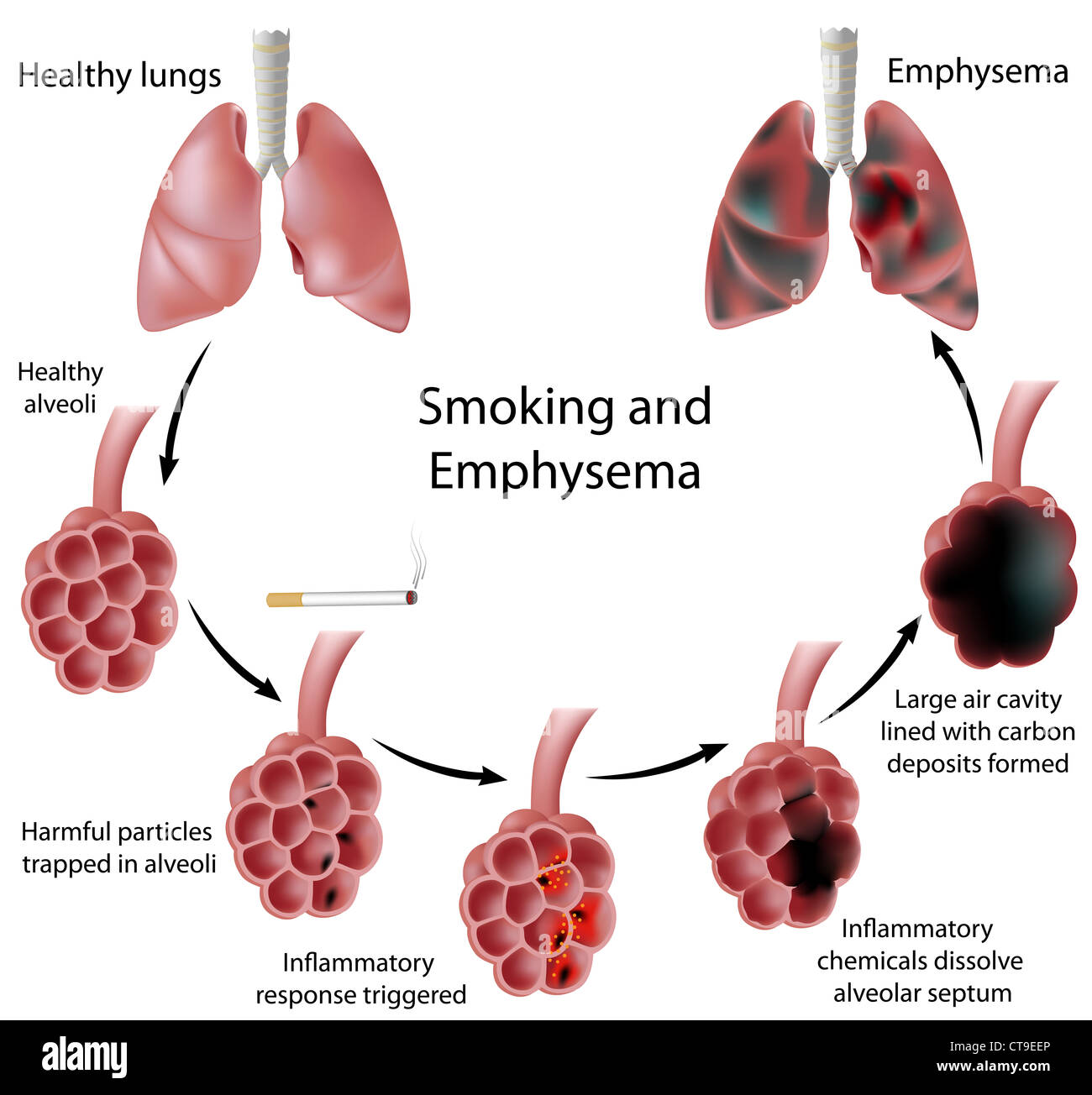 Smoking and Emphysema Stock Photo Alamy