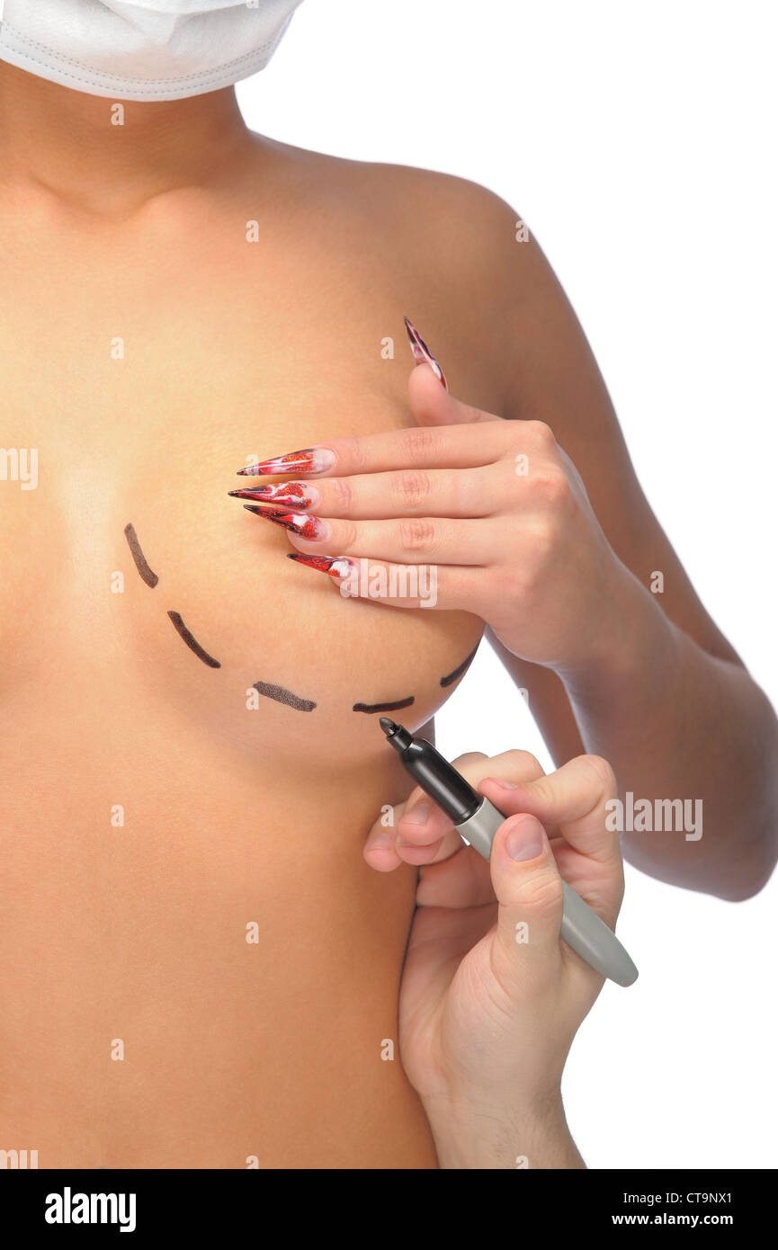 Closeup photo of a Caucasian woman's breasts marked with lines for breast modification Stock Photo