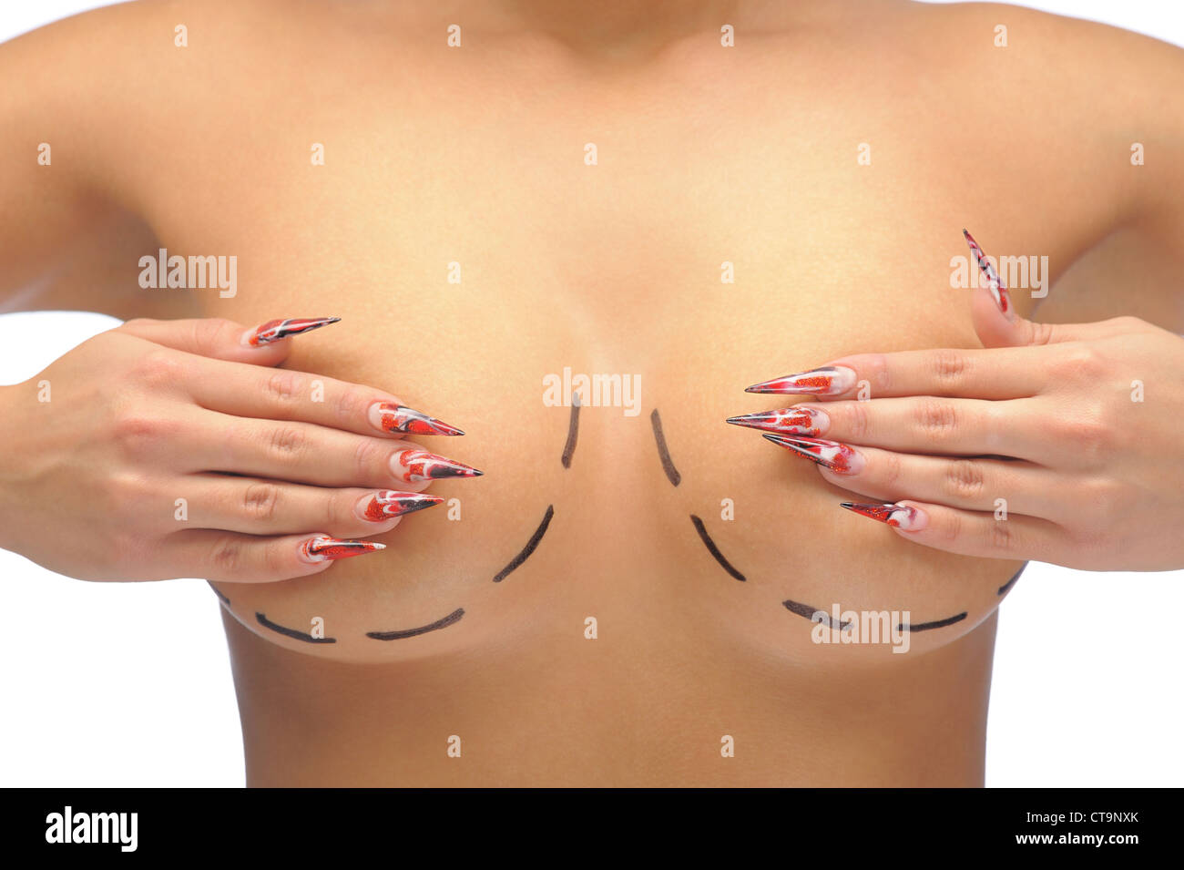 Closeup photo of a Caucasian woman's breasts marked with lines for breast modification Stock Photo