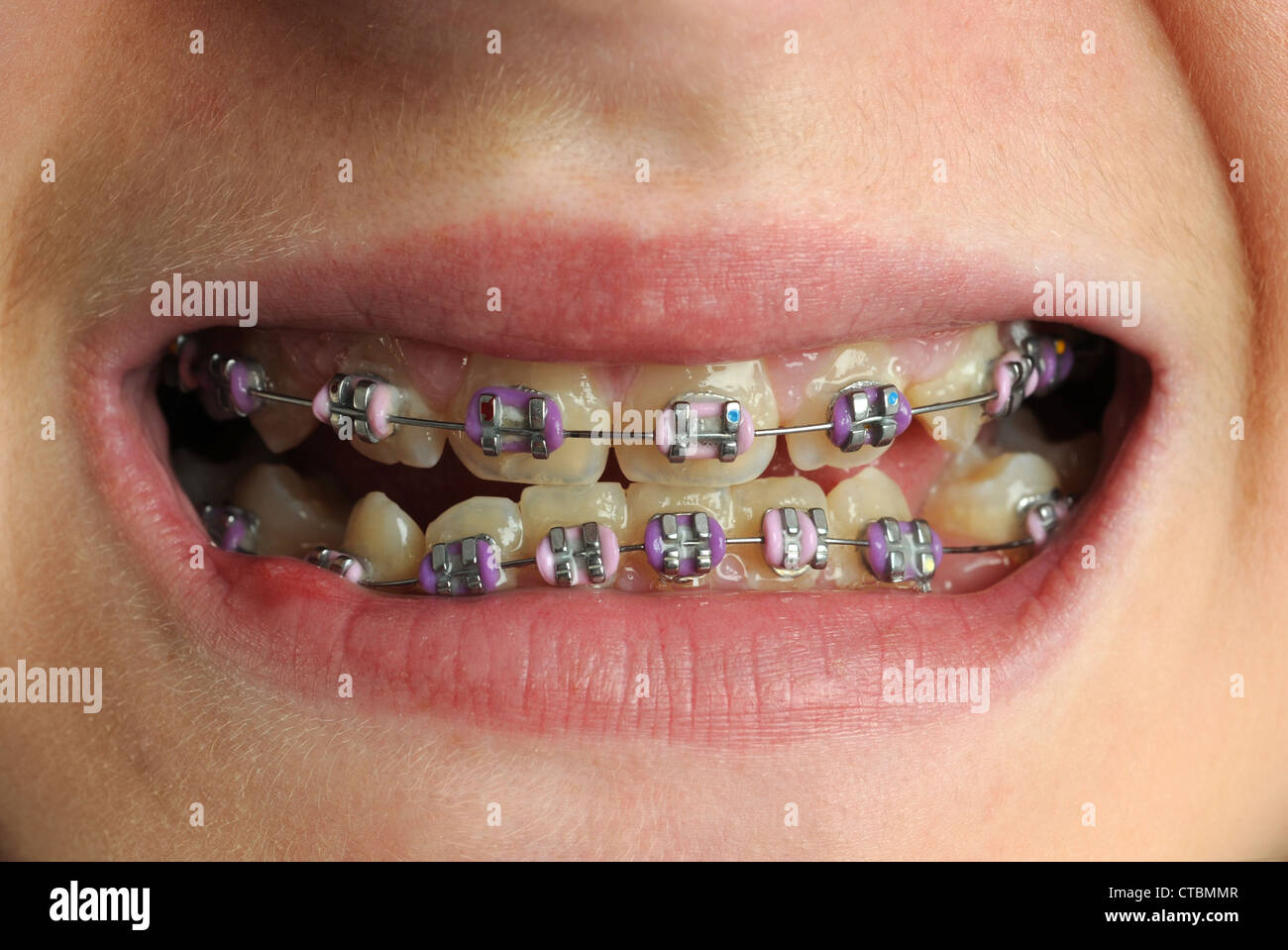 Dental Braces Wikipedia | atelier-yuwa.ciao.jp