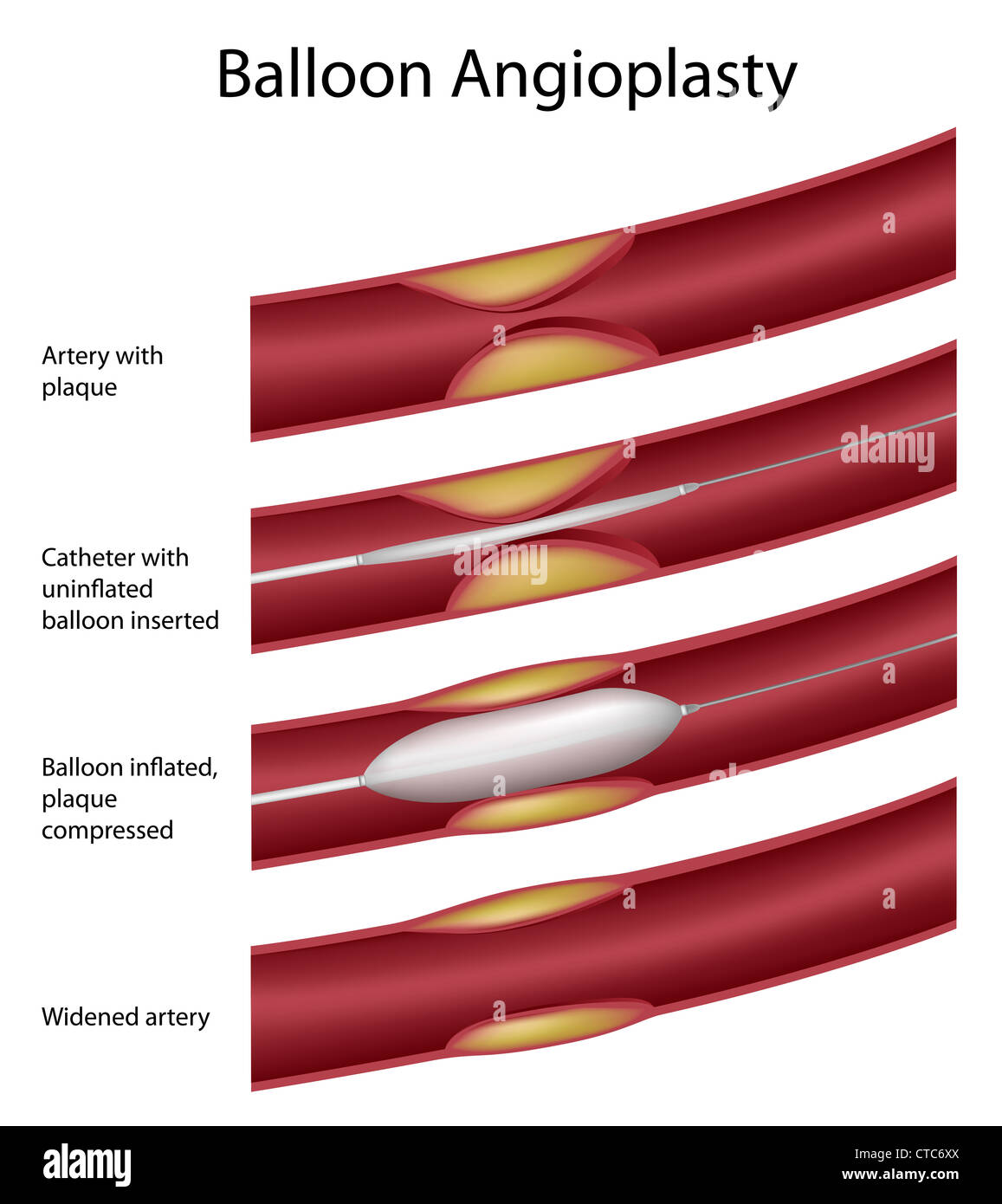 Balloon angioplasty procedure Stock Photo Alamy