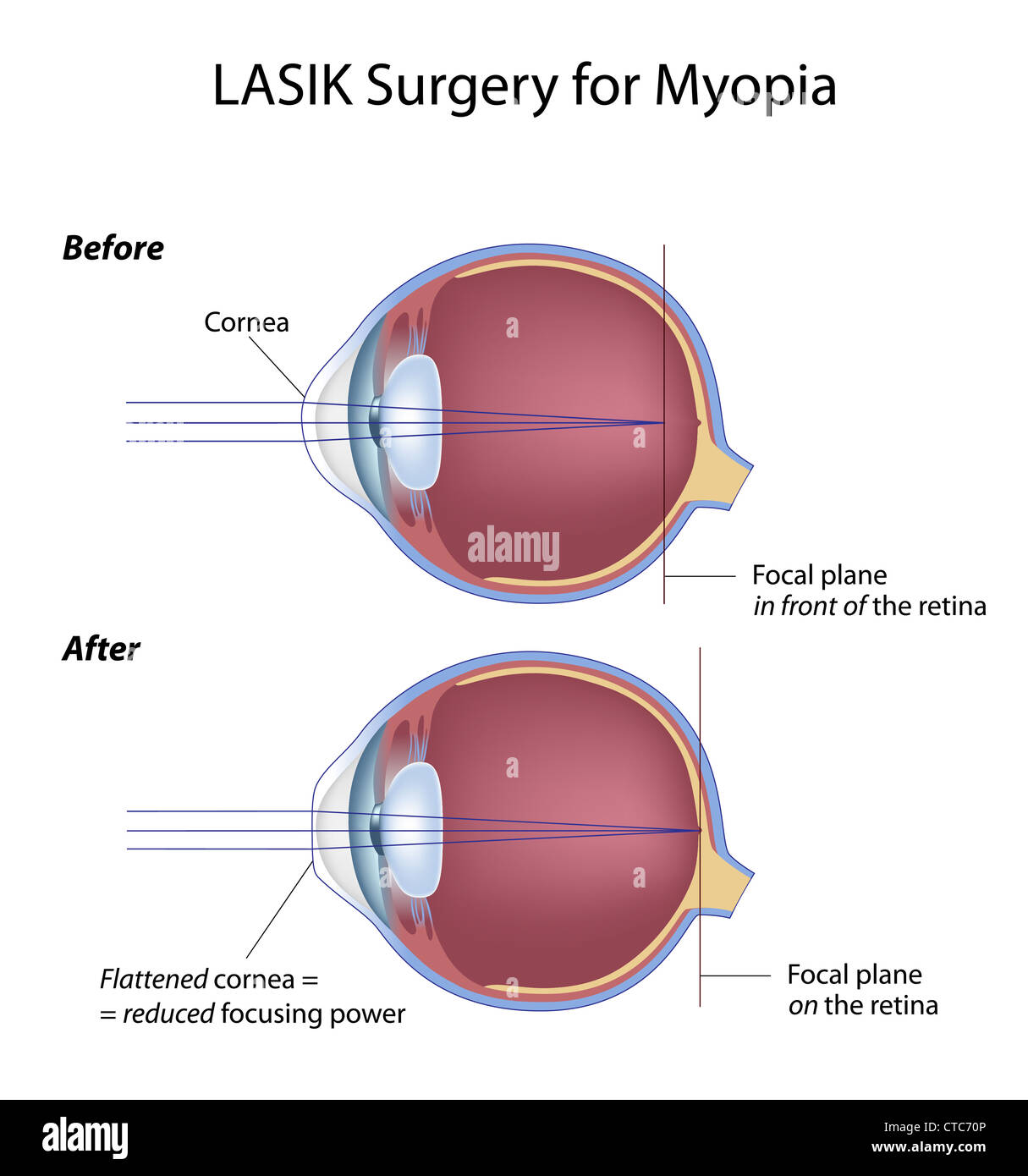 Lasik eye surgery for myopia Stock Photo
