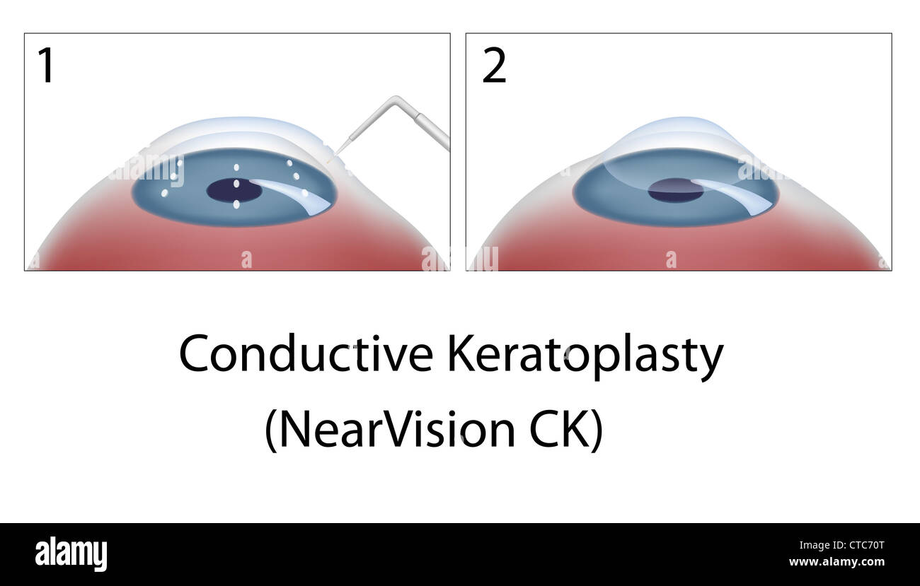 Conductive Keratoplasty eye surgery Stock Photo