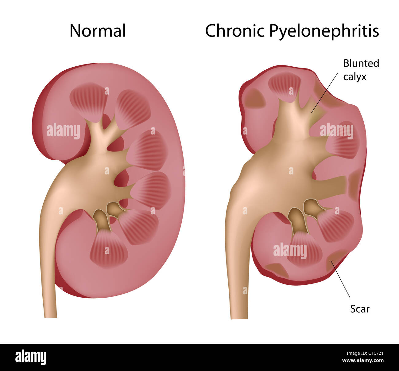 Kidney Chronic pyelonephritis Stock Photo Alamy