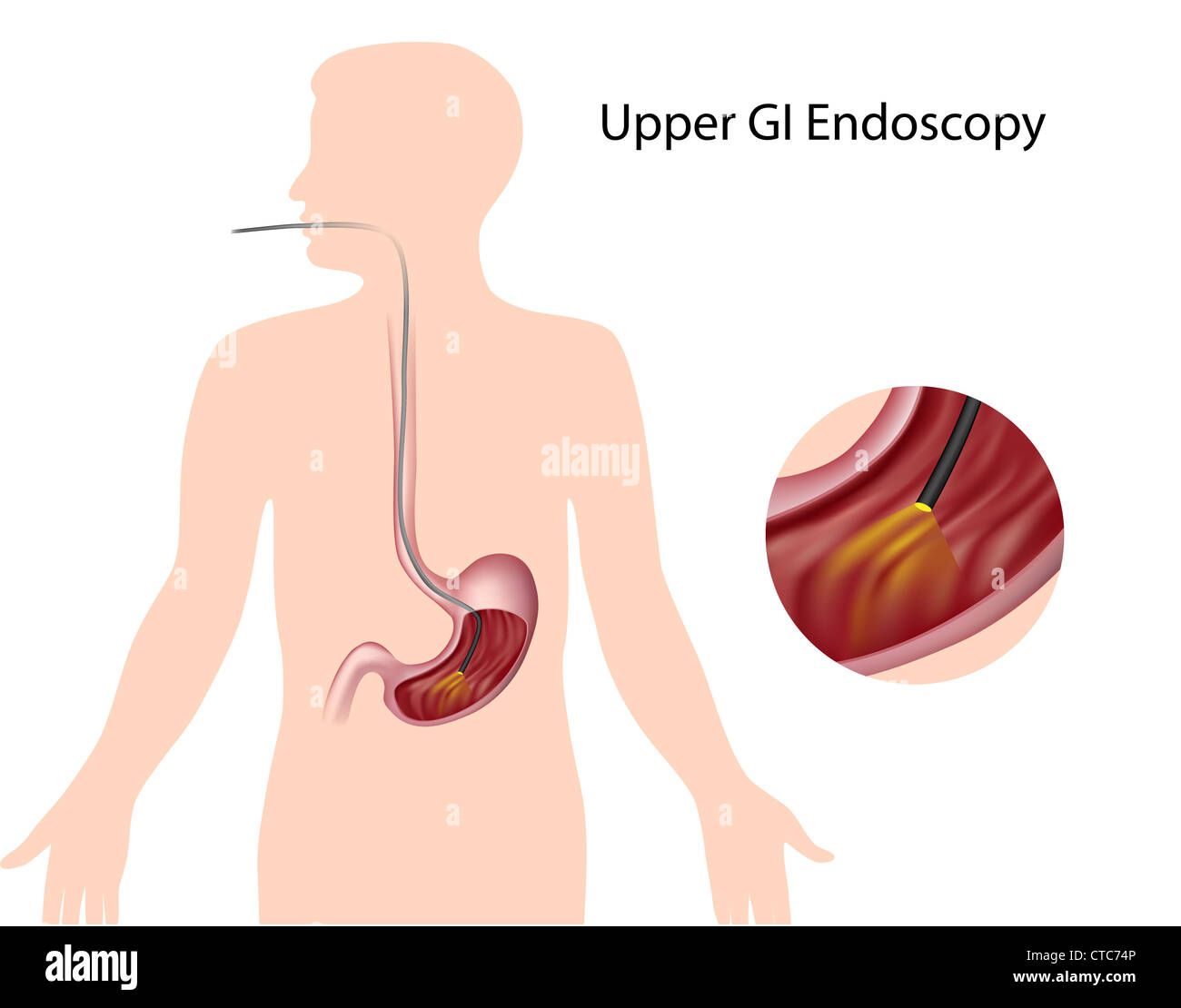 Upper gastrointestinal endoscopy Stock Photo