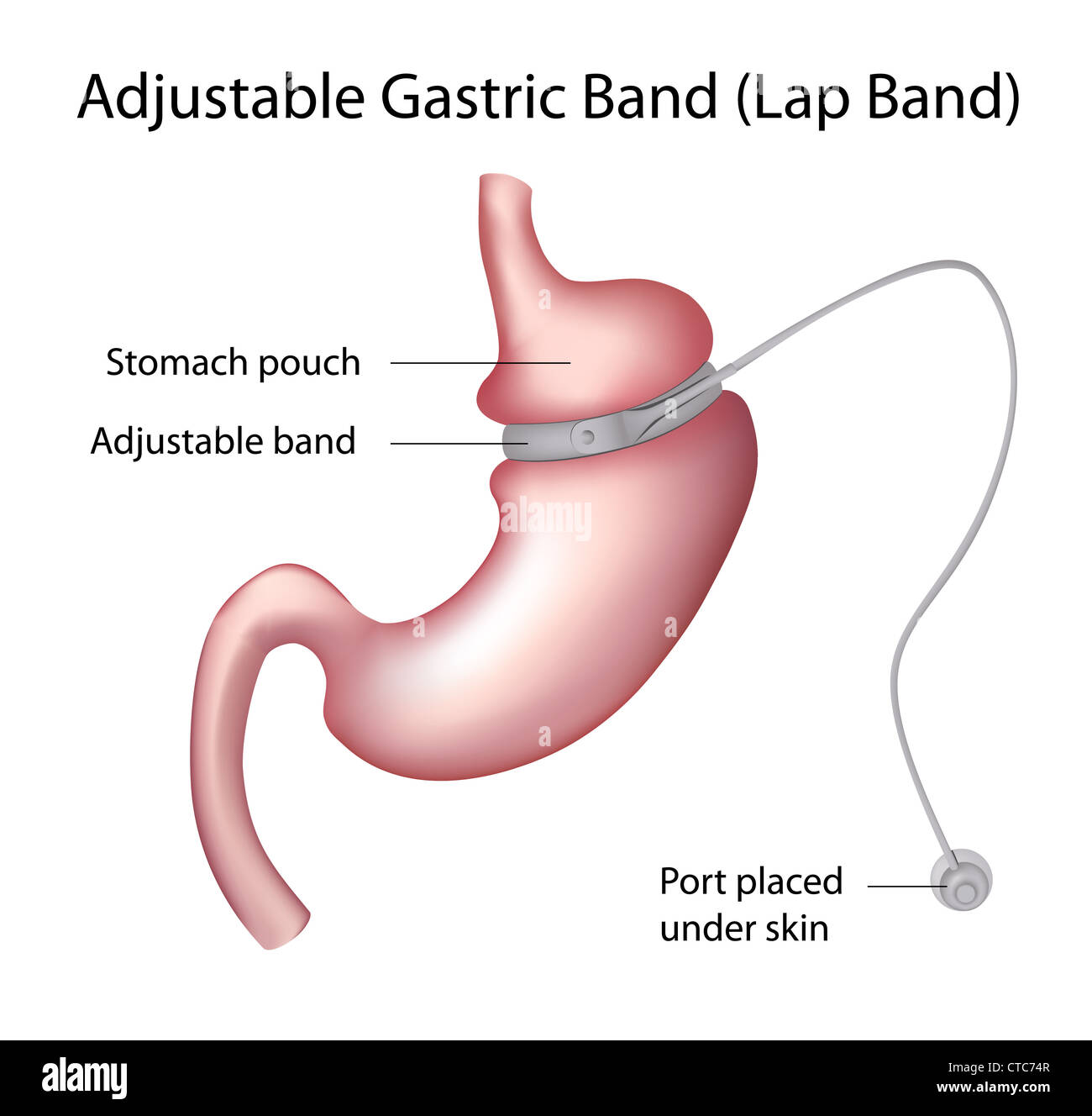 Gastric Banding Surgery | Lap Band Surgery Perth