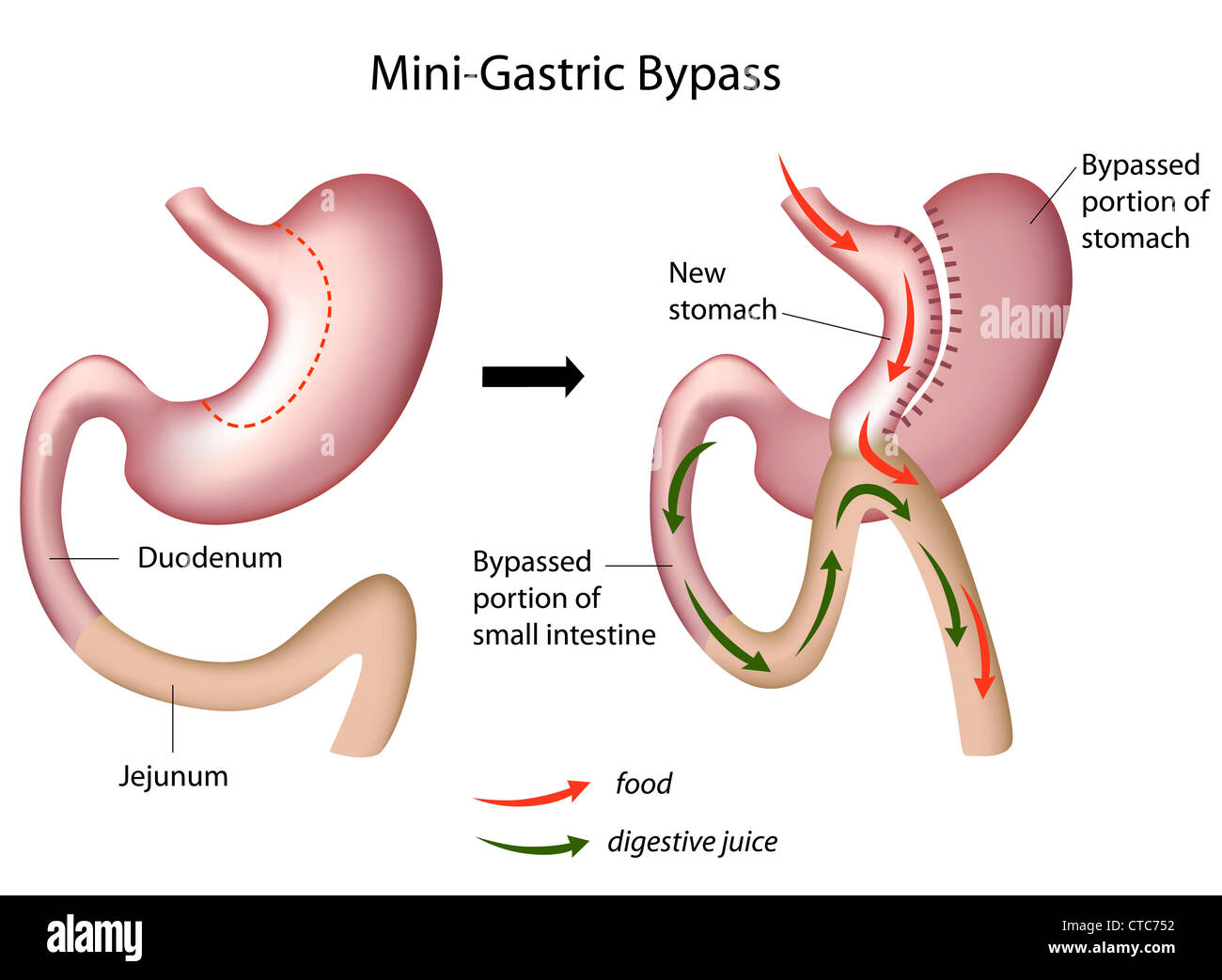 Mini gastric bypass surgery Stock Photo