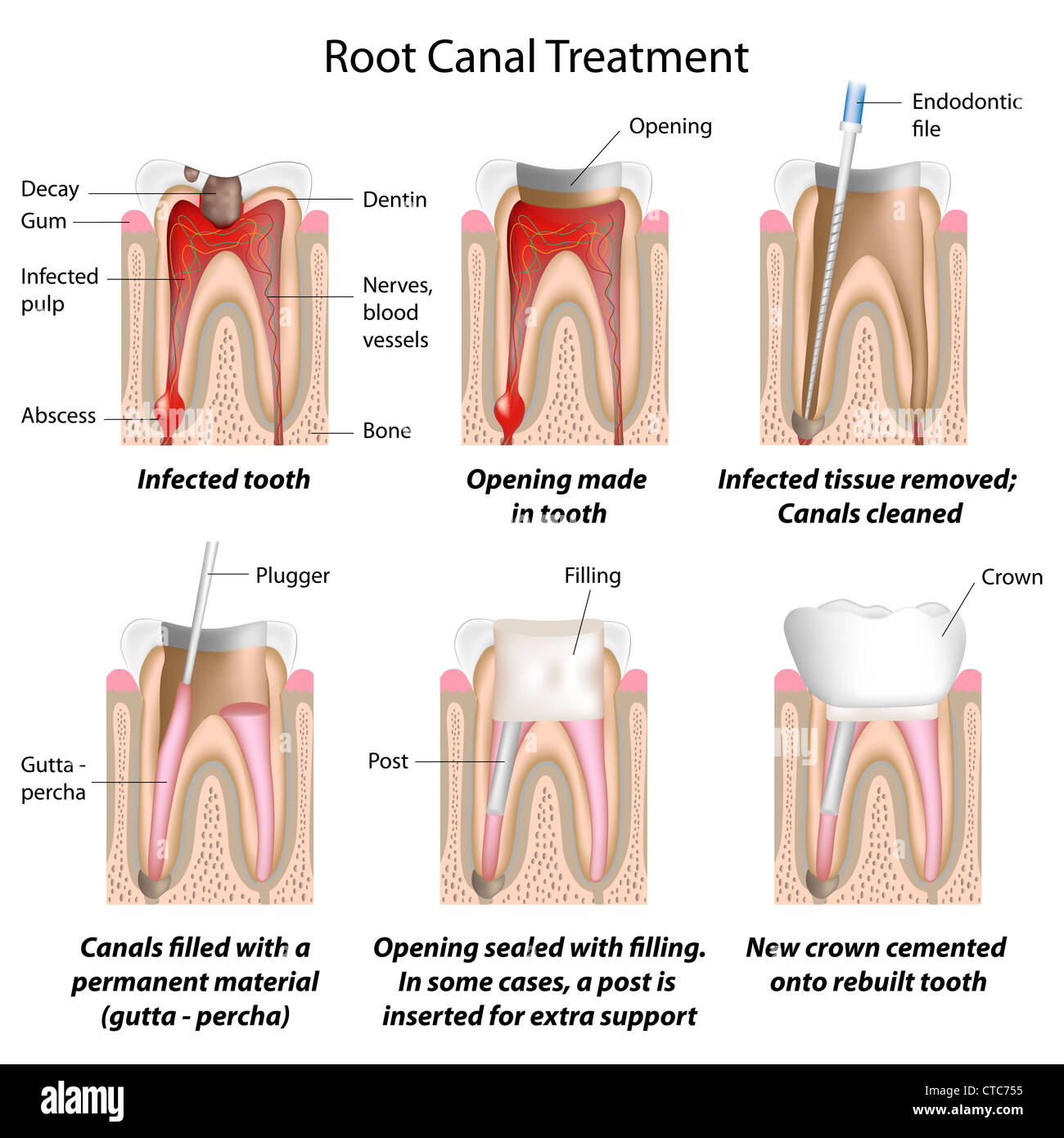 Root canal treatment Stock Photo