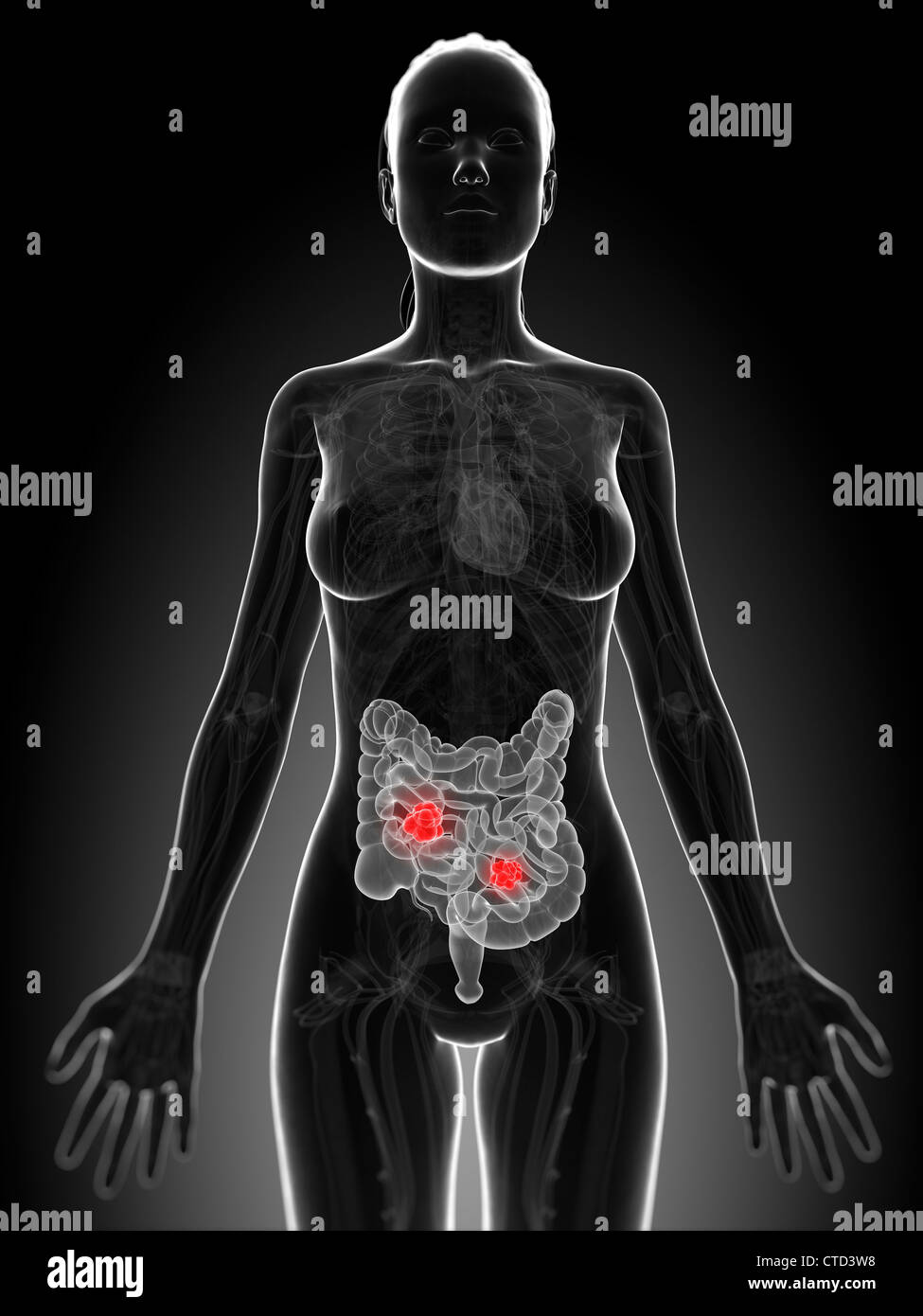 Intestinal tumors hi-res stock photography and images - Alamy