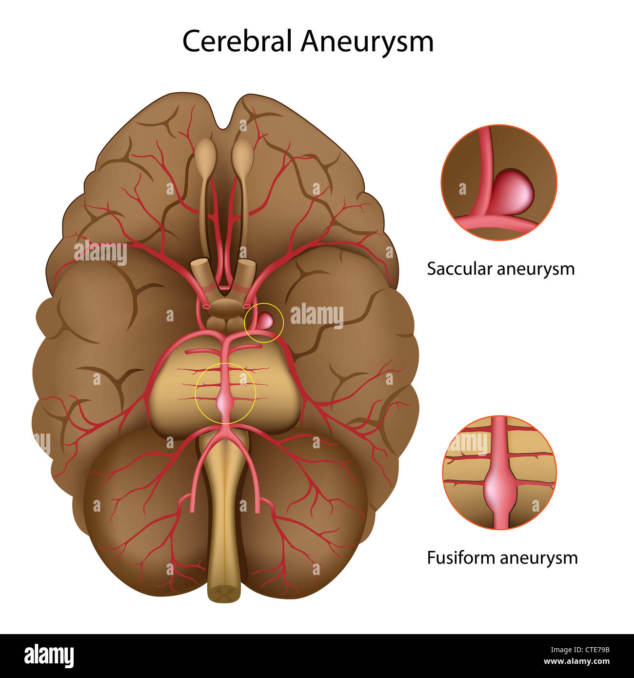 Cerebral aneurysm Stock Photo