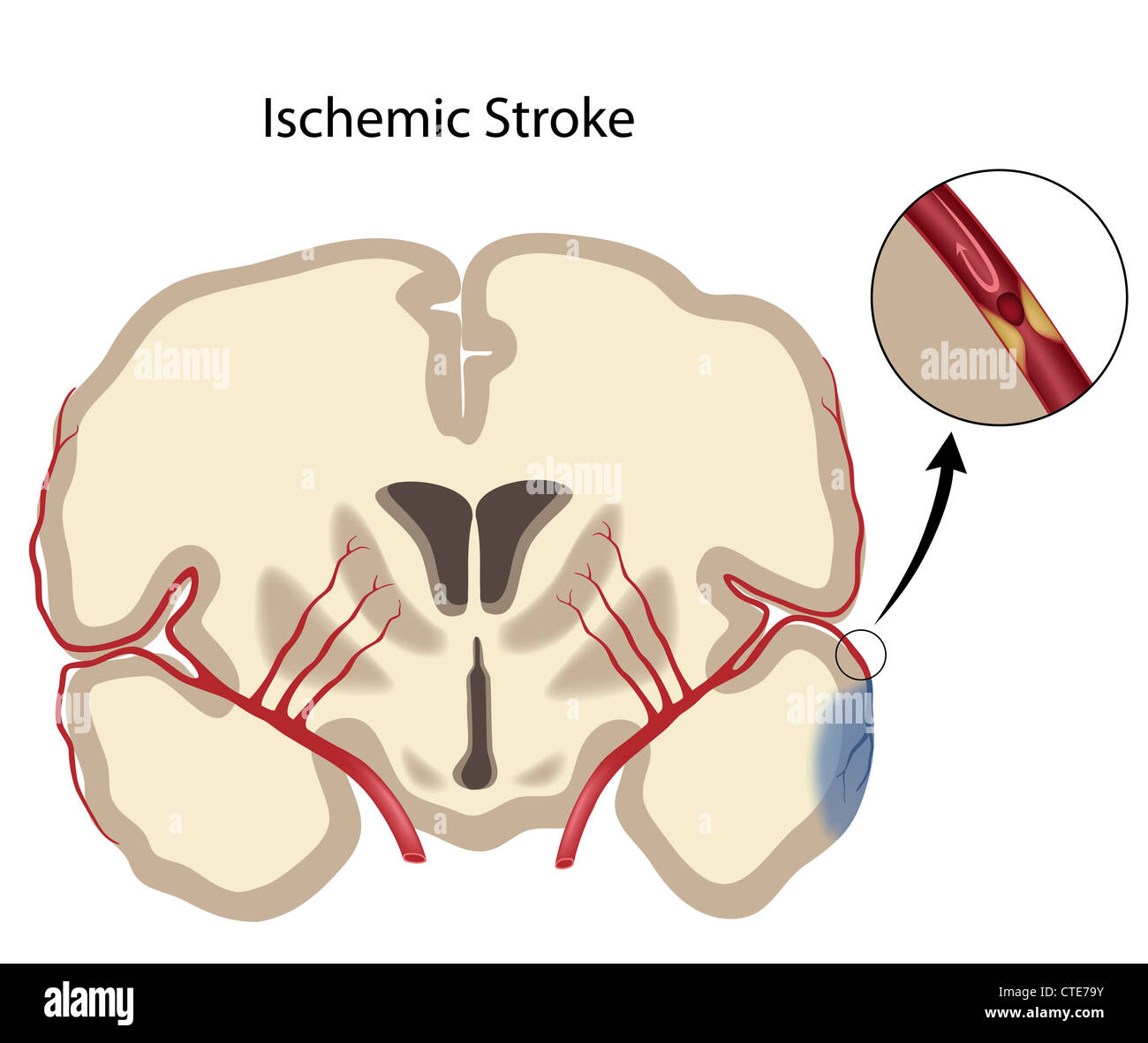 Brain ischemic stroke Stock Photo Alamy