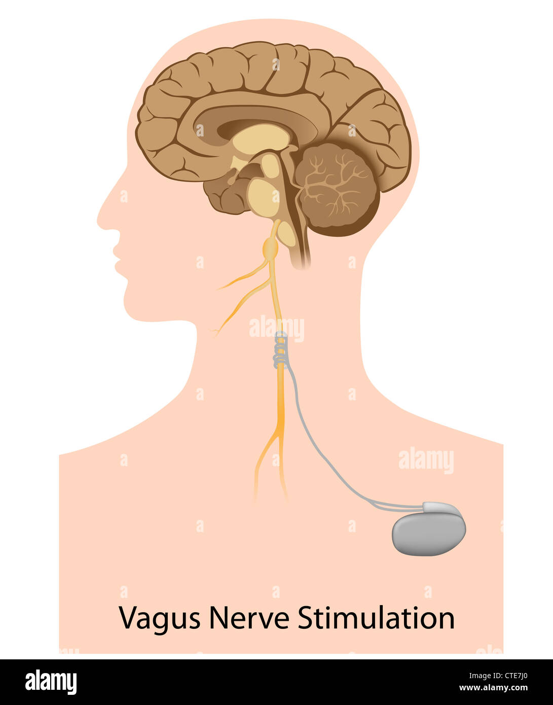 Vagus Nerve Stimulation Device Stimulate Electrical Stock Vector