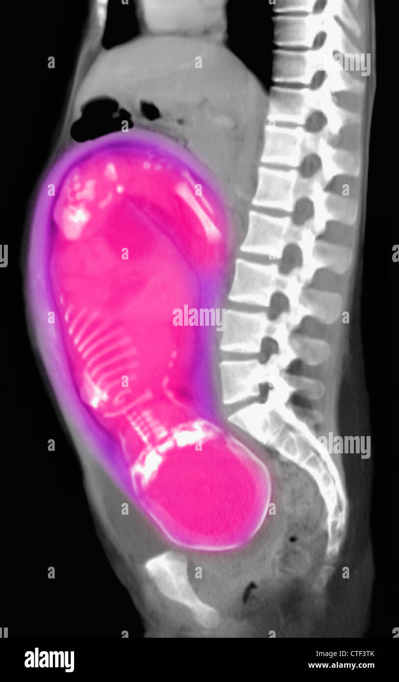 Ct scan abdomen hires stock photography and images Alamy