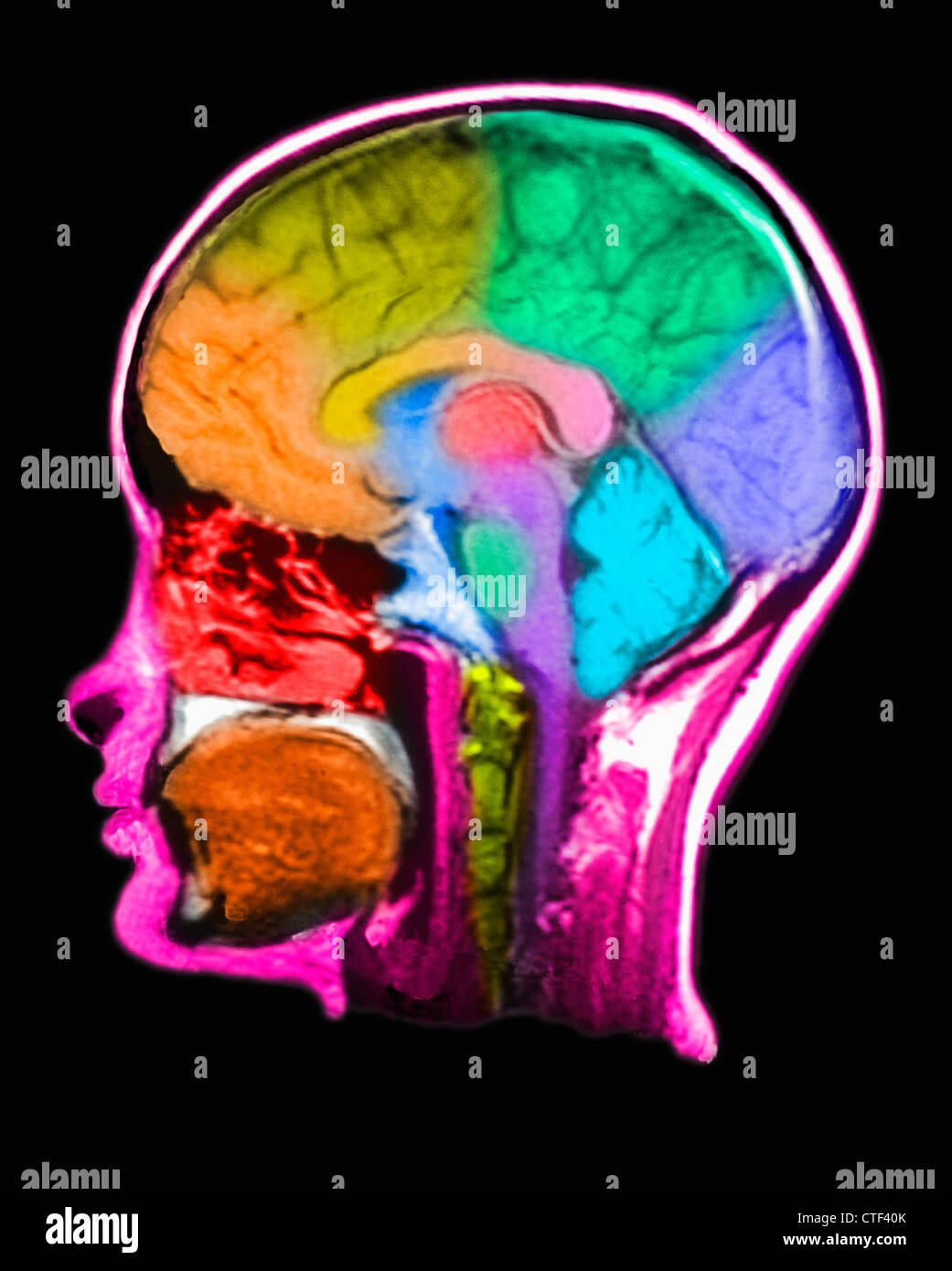 MRI Scan of human head Stock Photo