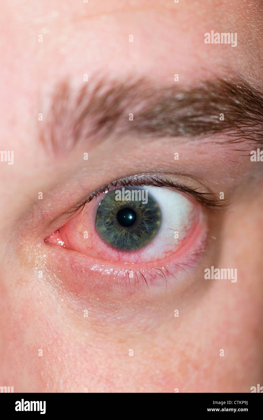 An allergic reaction in the human eye Stock Photo Alamy