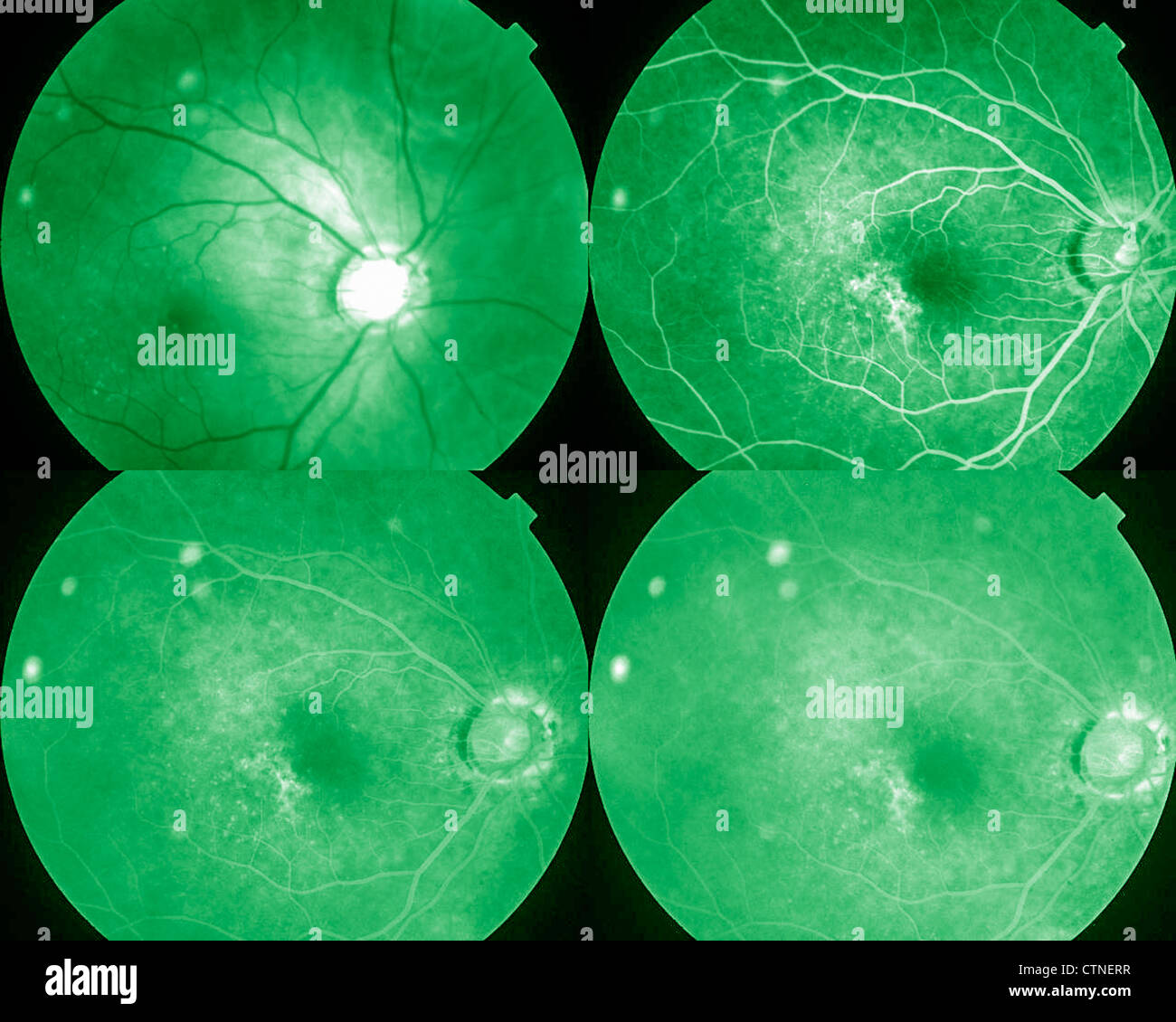 Four phases eye angiogram Stock Photo
