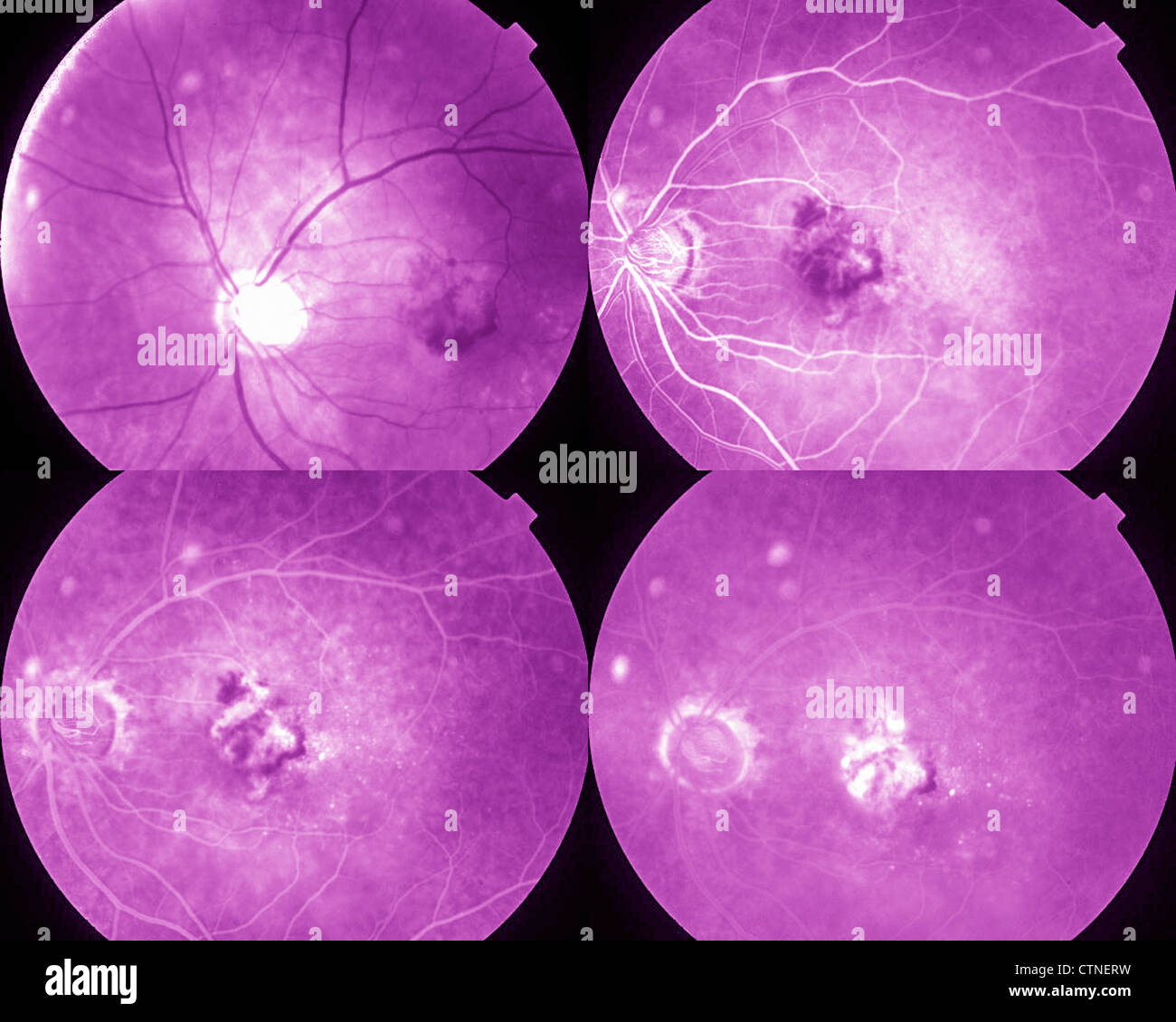 Four phases eye angiography showing AMD age-related macular degeneration Stock Photo