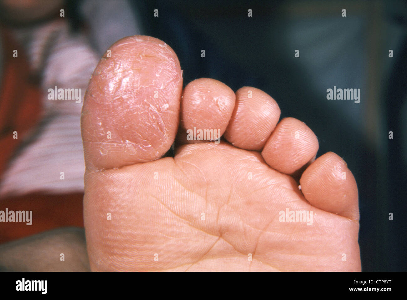 Geotrichum fungus infection of the great toe. Stock Photo