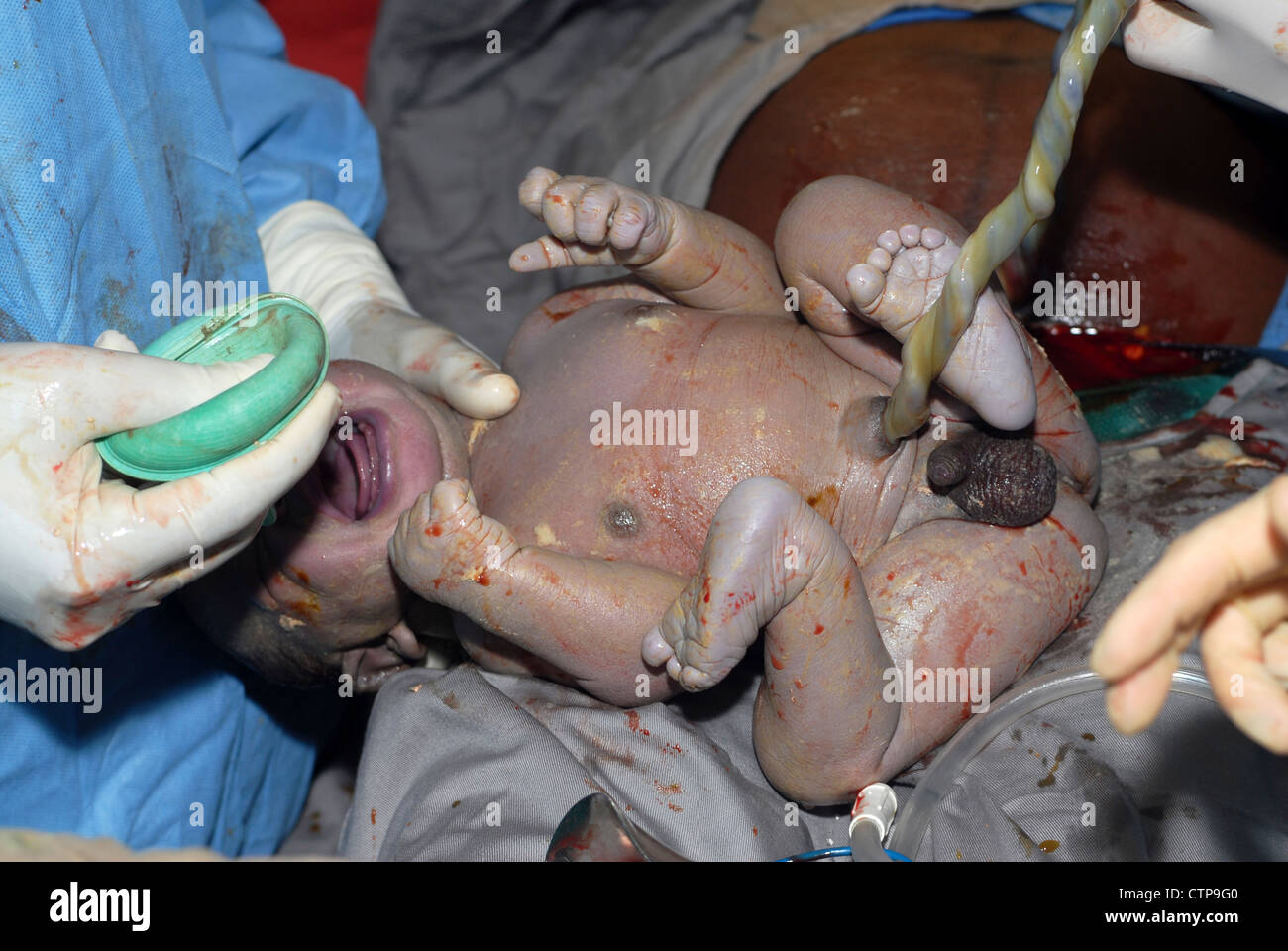 Infant delivered by Caesarean section. Stock Photo
