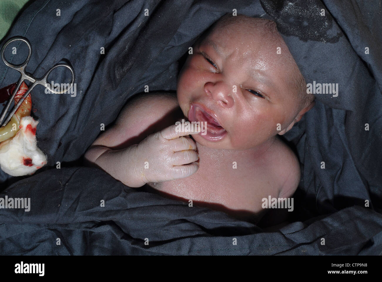 Infant delivered by Caesarean section. Stock Photo