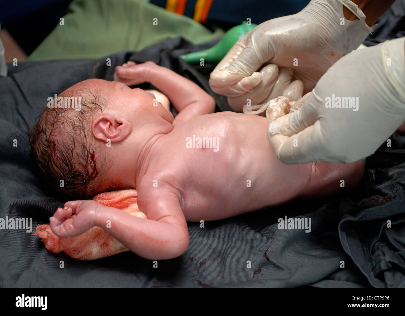Infant delivered by Caesarean section. Stock Photo