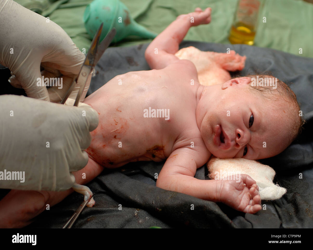 Infant delivered by Caesarean section. Stock Photo