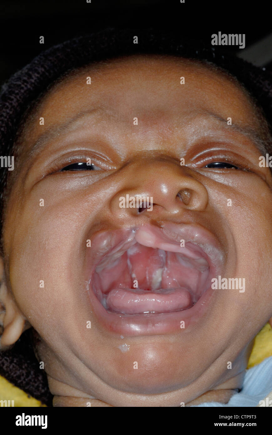 cleft lip and cleft palate on a young Nigerian baby Stock Photo