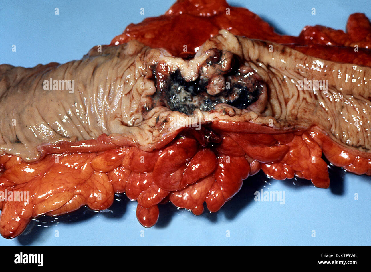 Adenocarcinoma of the colon.  Pathology specimen. Stock Photo