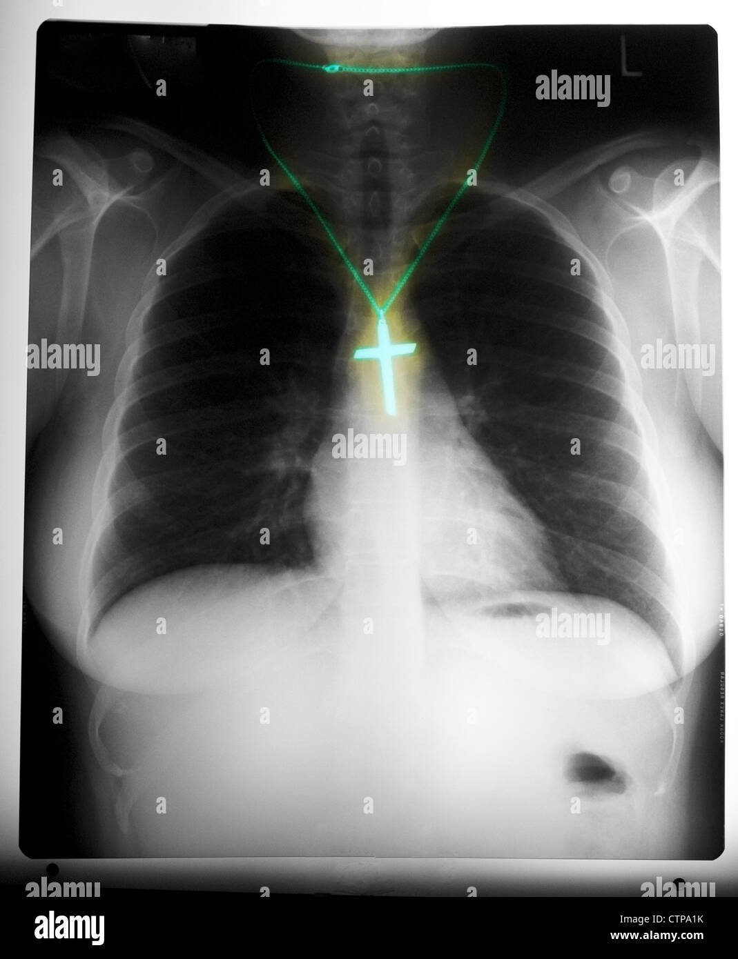 chest x-ray of a woman wearing a cross Stock Photo